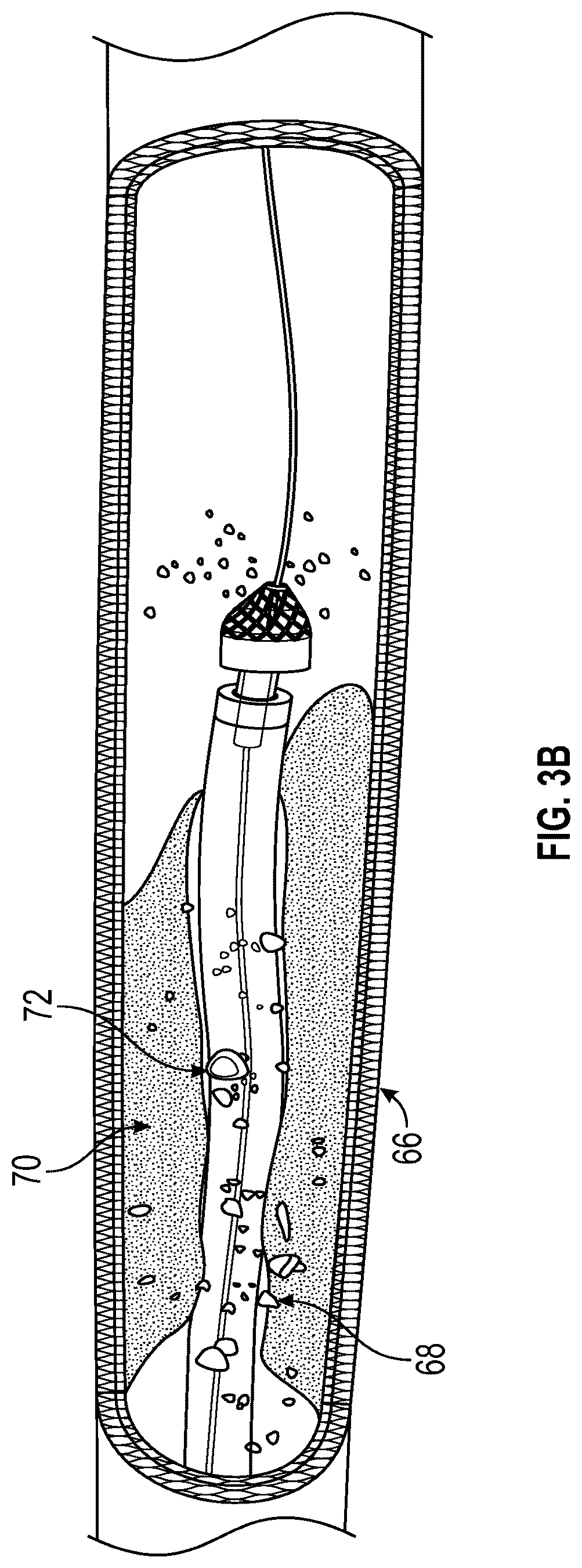 Patent US12588926 Figure 4 – Devices and methods for removal of material in a vasculature