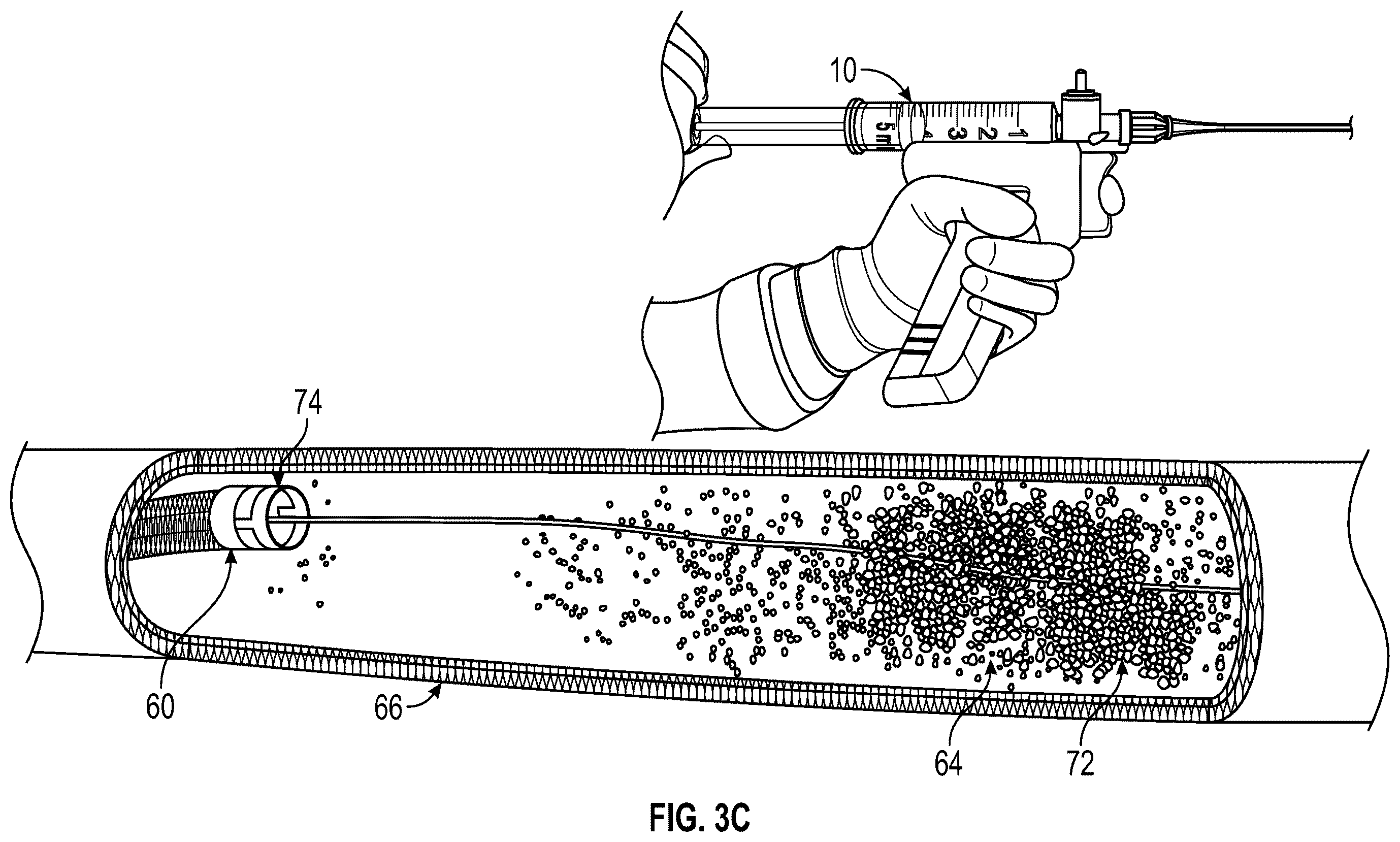 Patent US12588926 Figure 5 – Devices and methods for removal of material in a vasculature