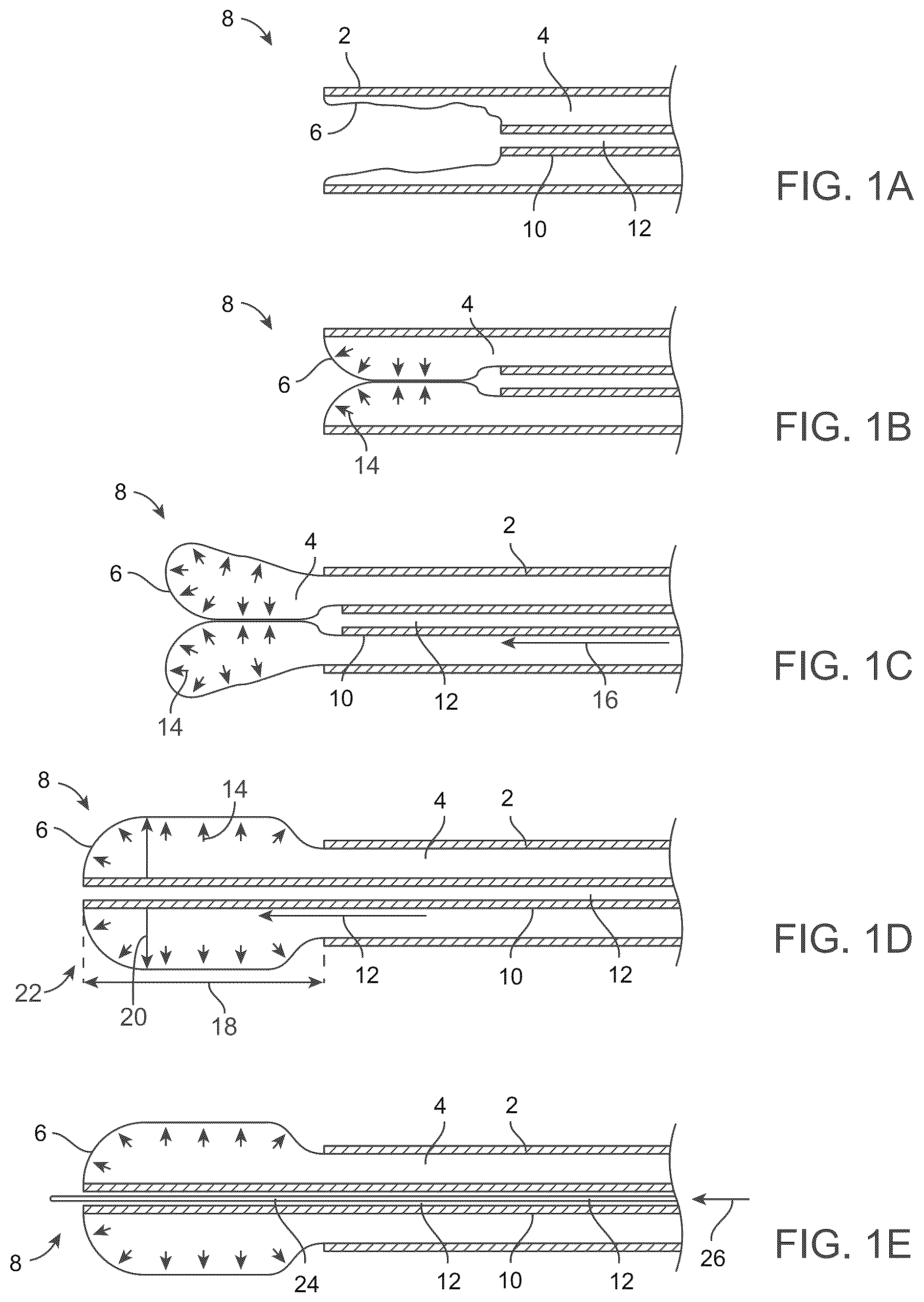 Patent US12588929 Figure 1 – Apparatus and method for everting catheter for embryo transfer using transvaginal ultrasound