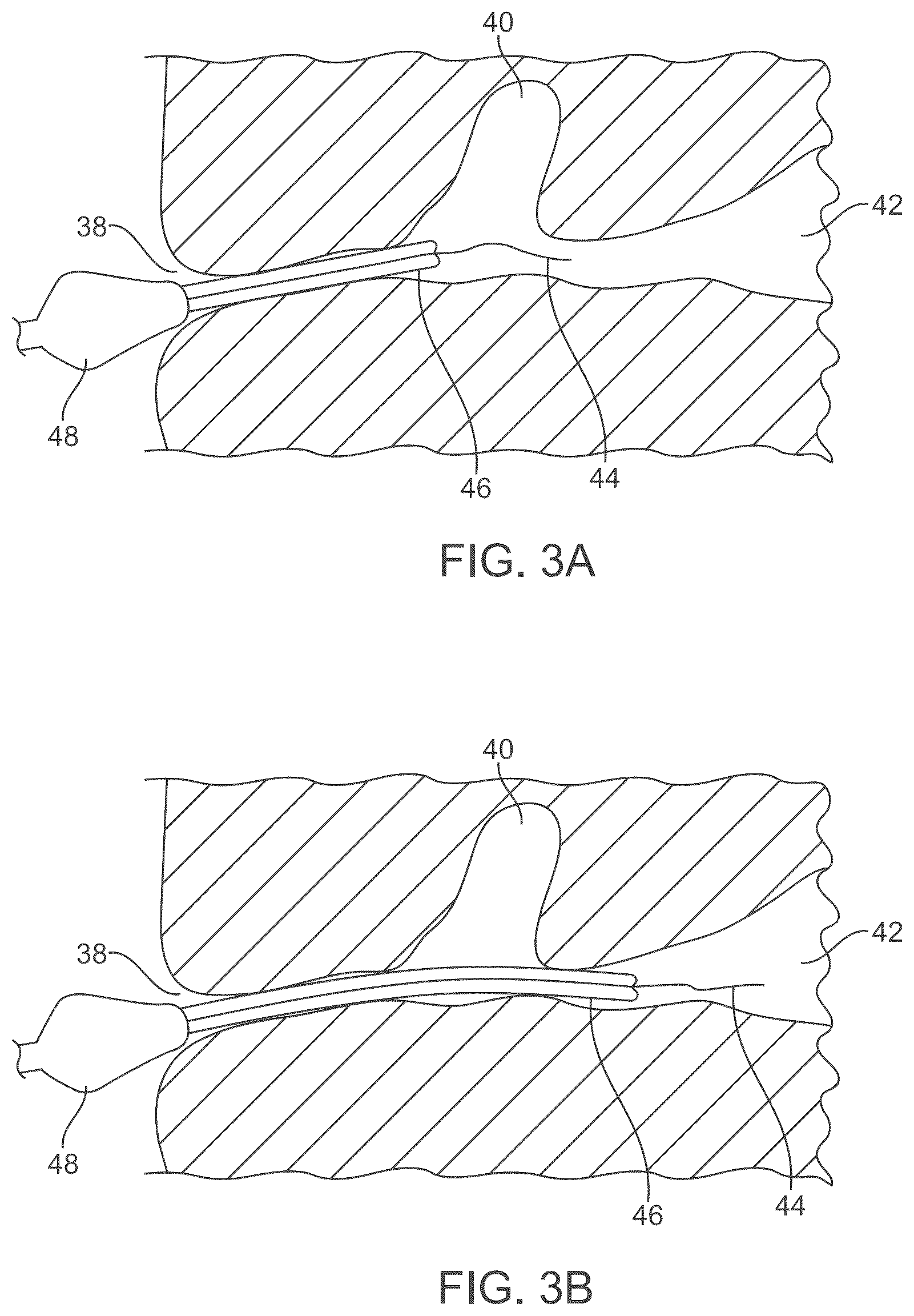 Patent US12588929 Figure 4 – Apparatus and method for everting catheter for embryo transfer using transvaginal ultrasound