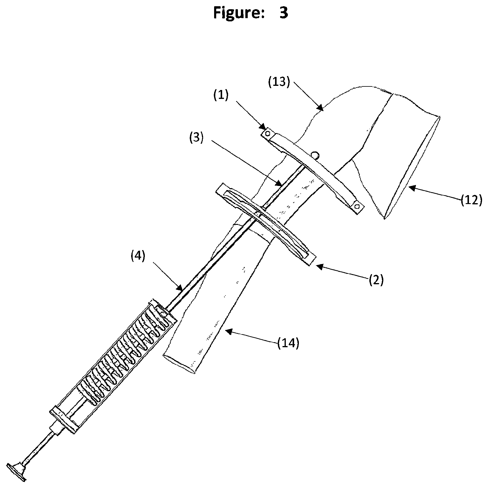 Patent US12588931 Figure 3 – Method and tool for measuring and correcting deformities for fractures and osteotomies