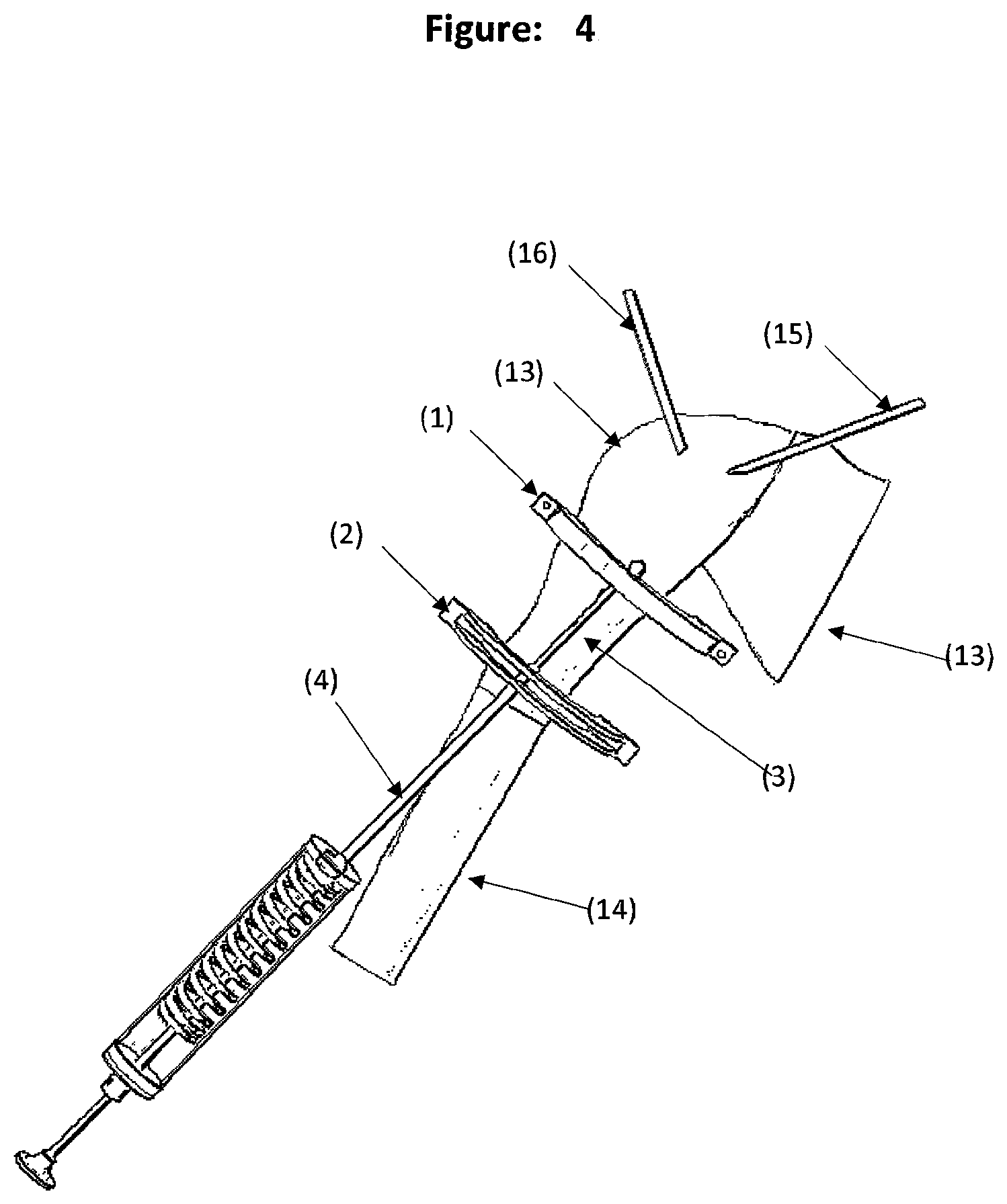 Patent US12588931 Figure 4 – Method and tool for measuring and correcting deformities for fractures and osteotomies