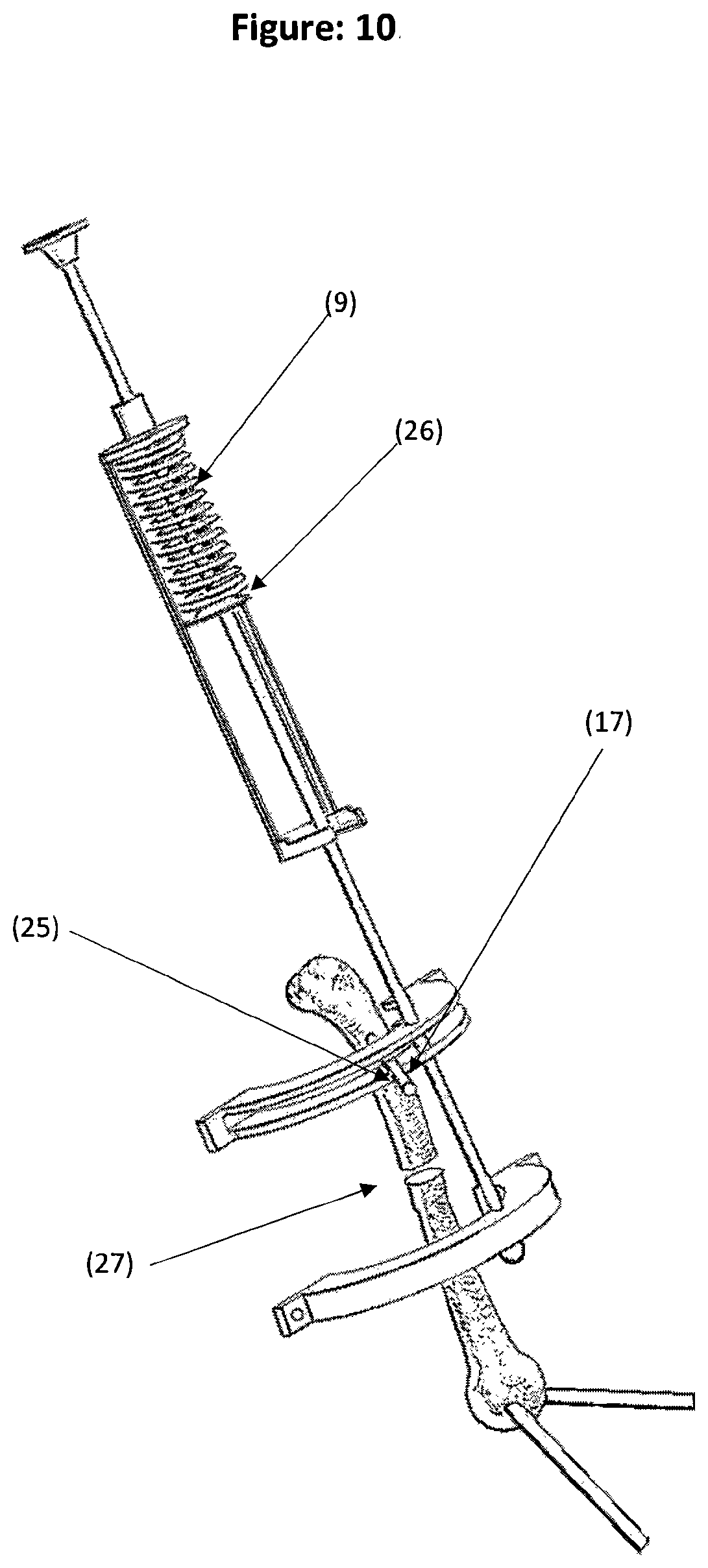Patent US12588931 Figure 10 – Method and tool for measuring and correcting deformities for fractures and osteotomies
