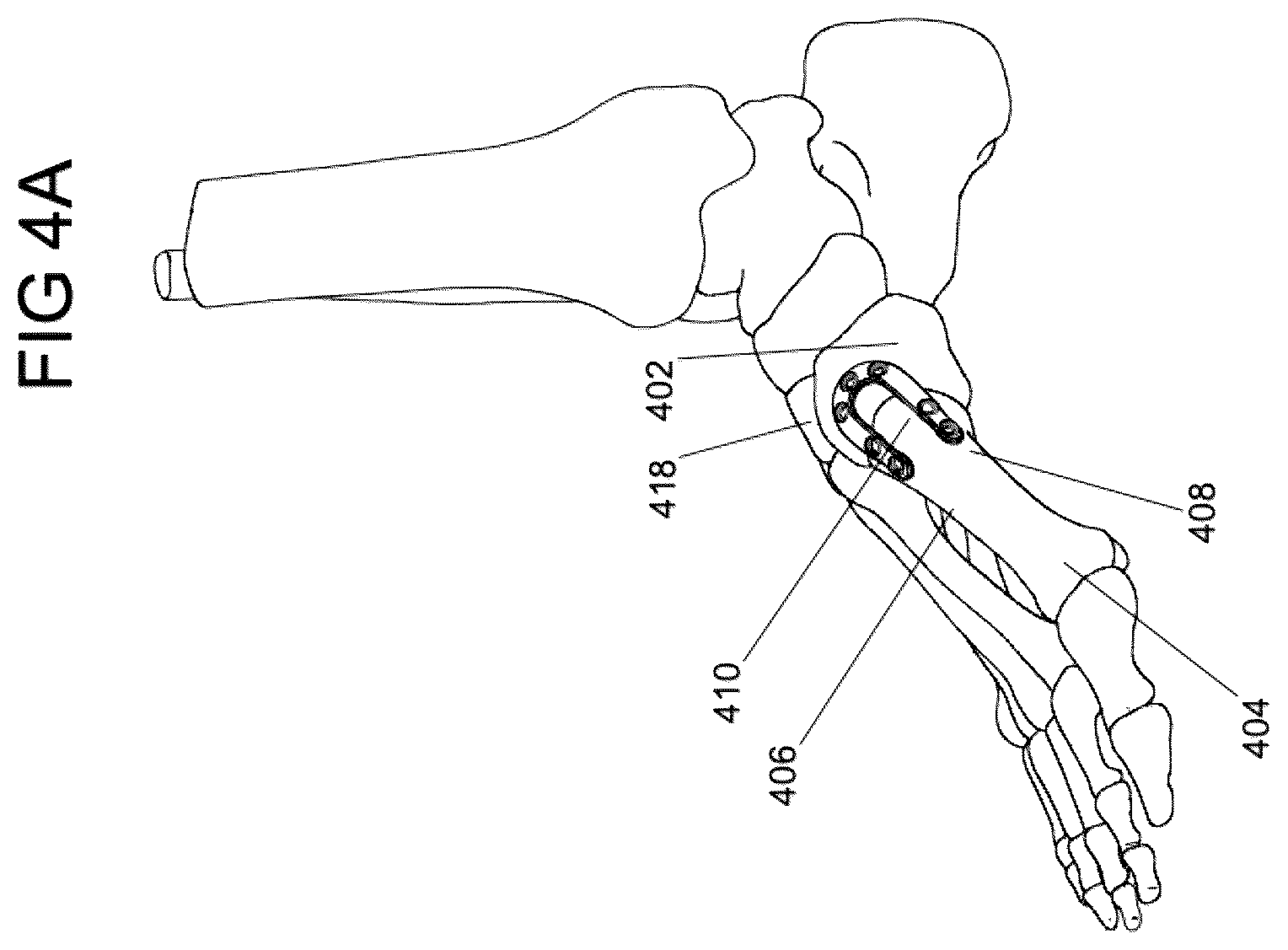Patent US12588932 Figure 4 – Multi-planar fixation system