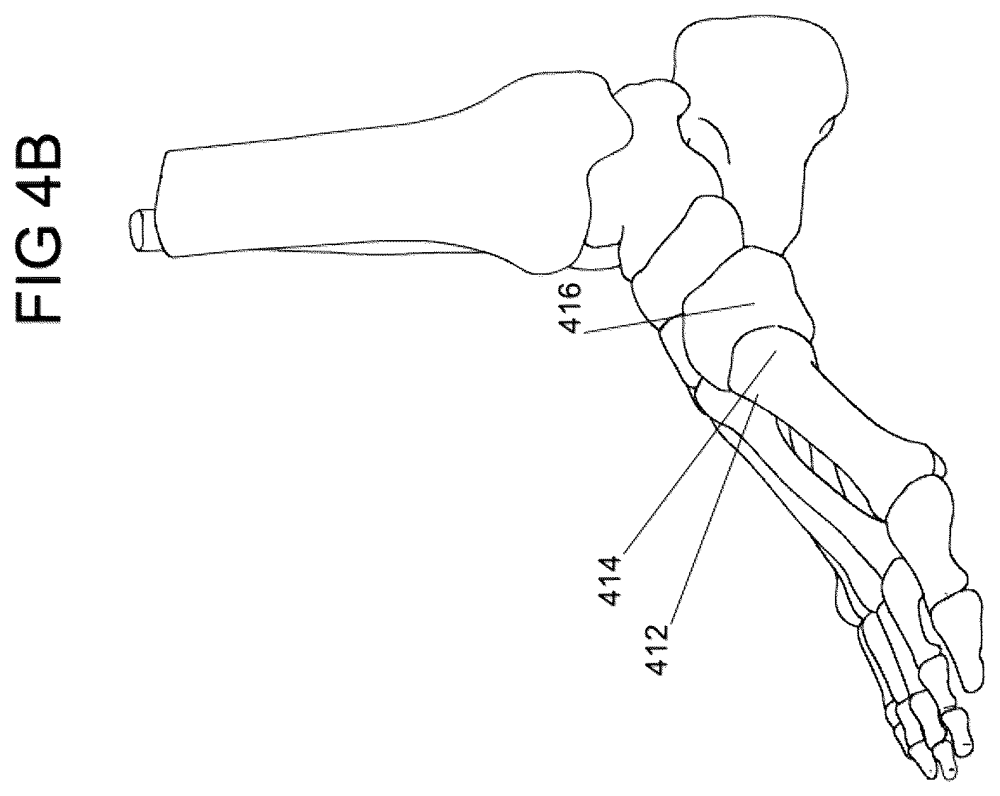 Patent US12588932 Figure 5 – Multi-planar fixation system