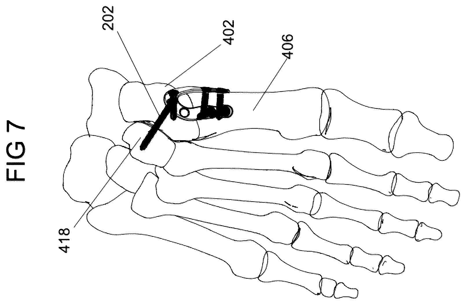 Patent US12588932 Figure 8 – Multi-planar fixation system