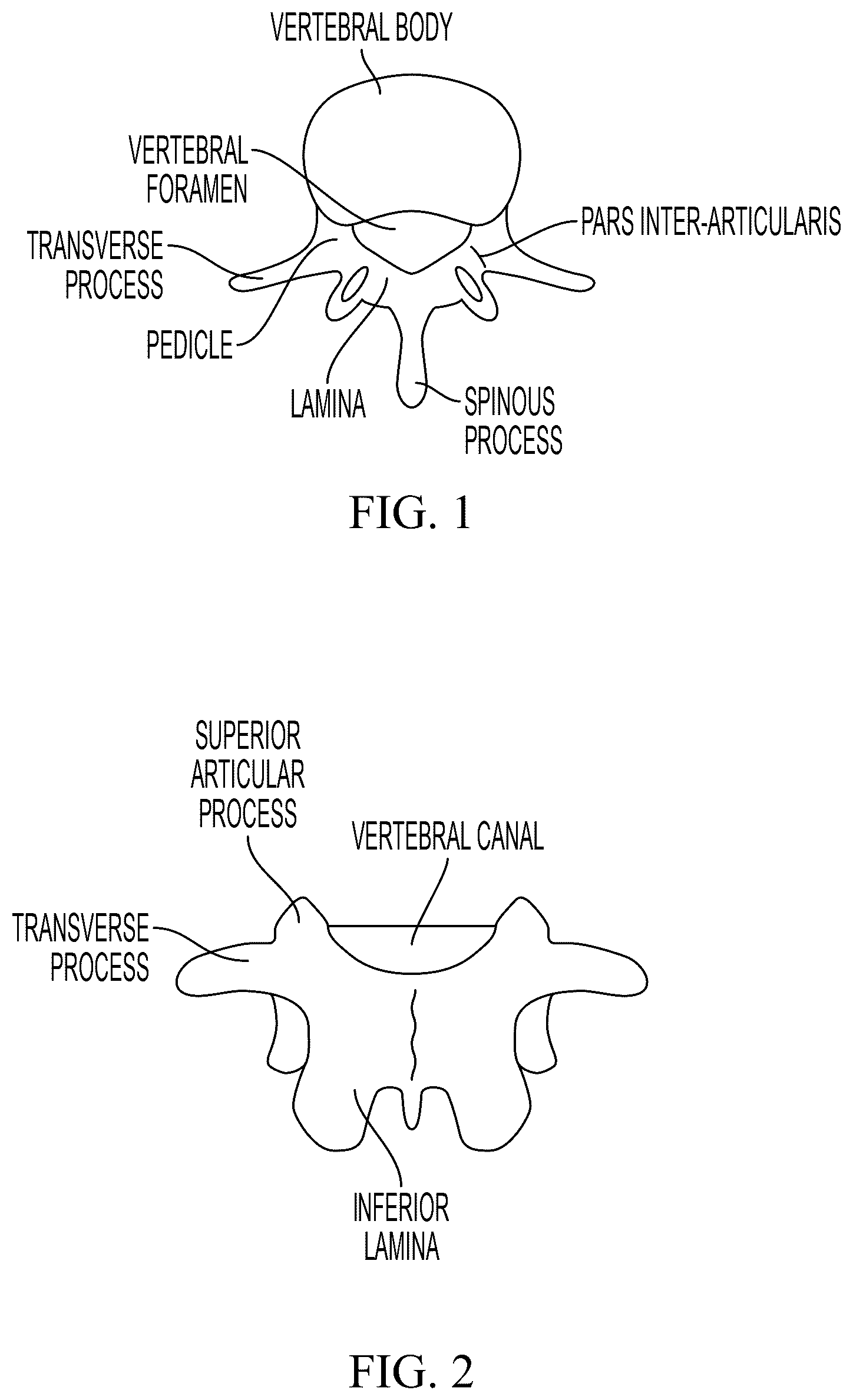 Patent US12588934 Figure 1 – Lumbar spondylolysis fracture fixation system