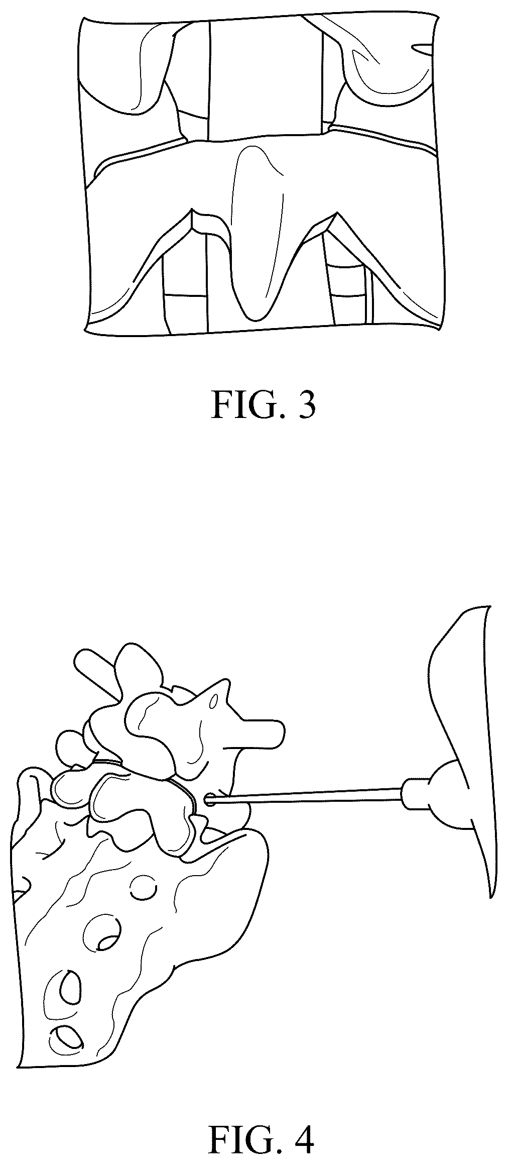 Patent US12588934 Figure 2 – Lumbar spondylolysis fracture fixation system