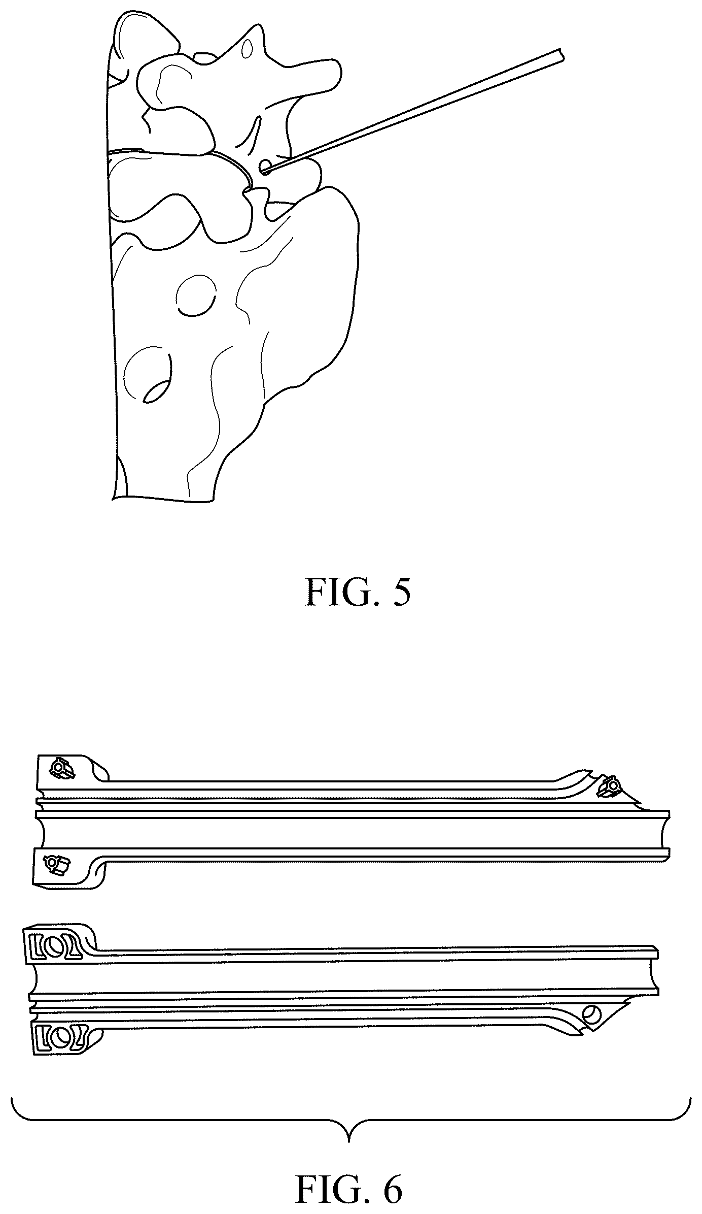 Patent US12588934 Figure 3 – Lumbar spondylolysis fracture fixation system