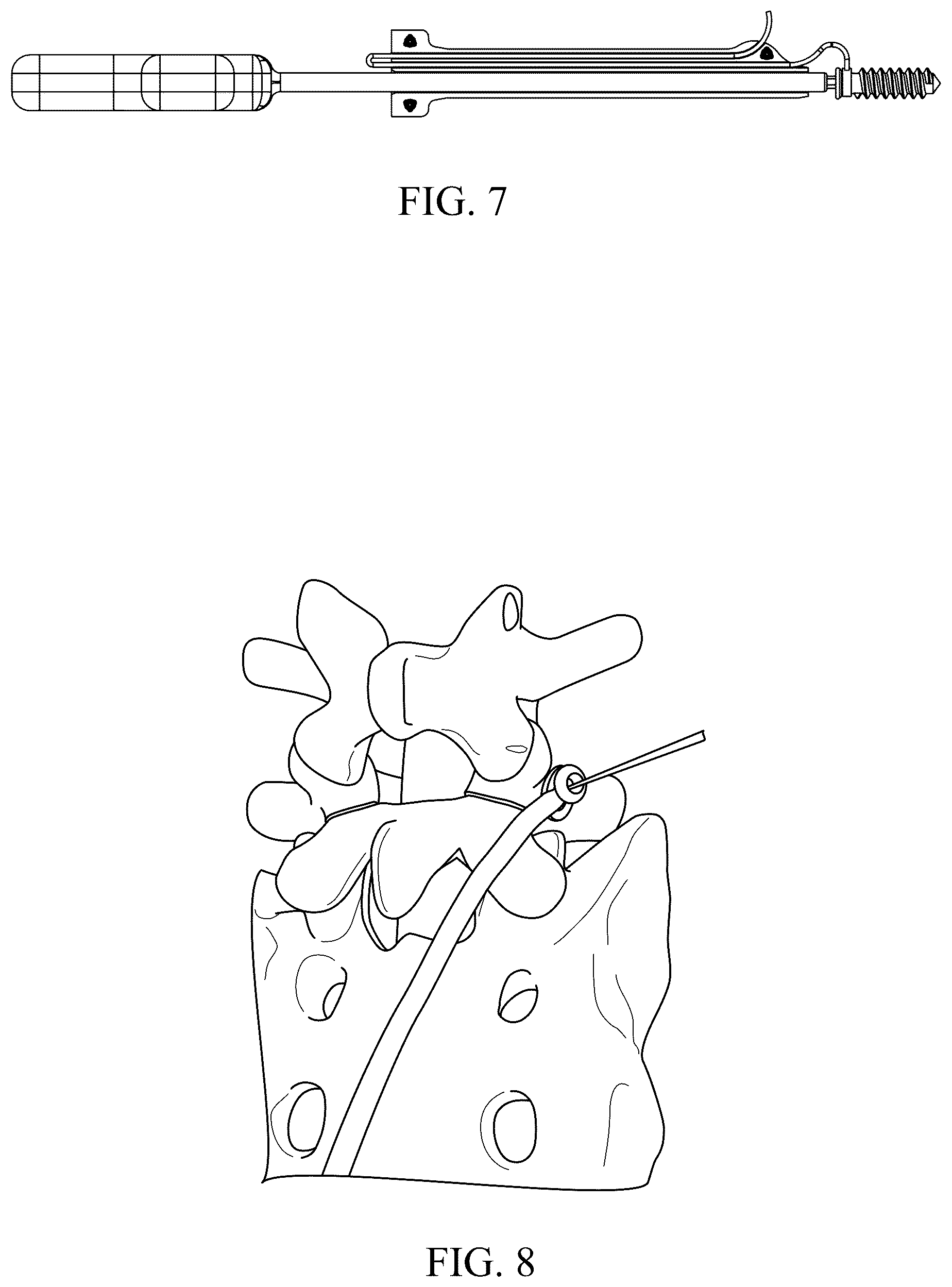 Patent US12588934 Figure 4 – Lumbar spondylolysis fracture fixation system