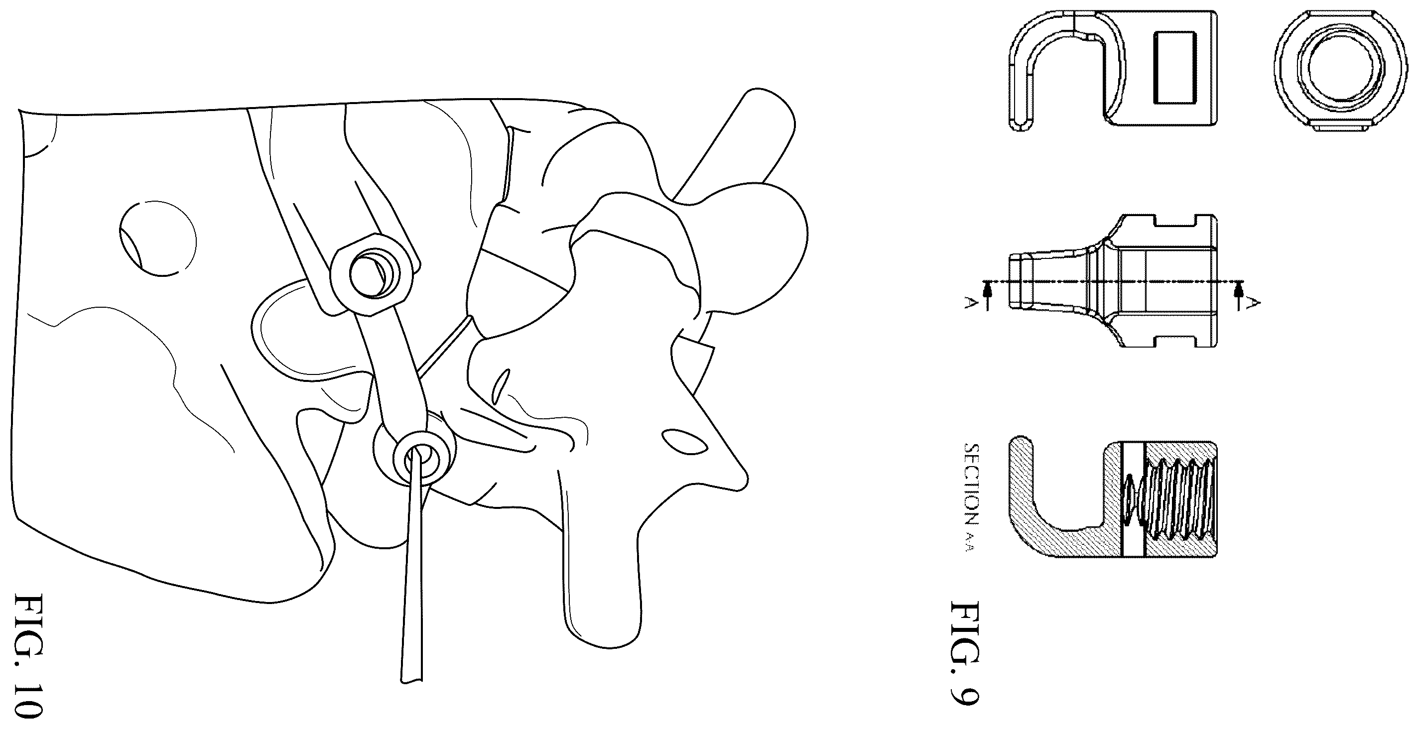 Patent US12588934 Figure 5 – Lumbar spondylolysis fracture fixation system