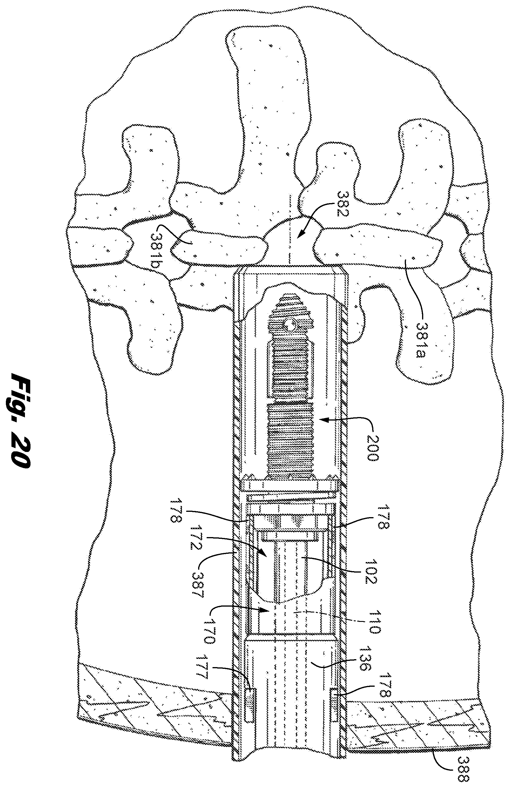 Patent US12588935 Figure 11 – Interspinous implant insertion instrument with staggered path implant deployment mechanism