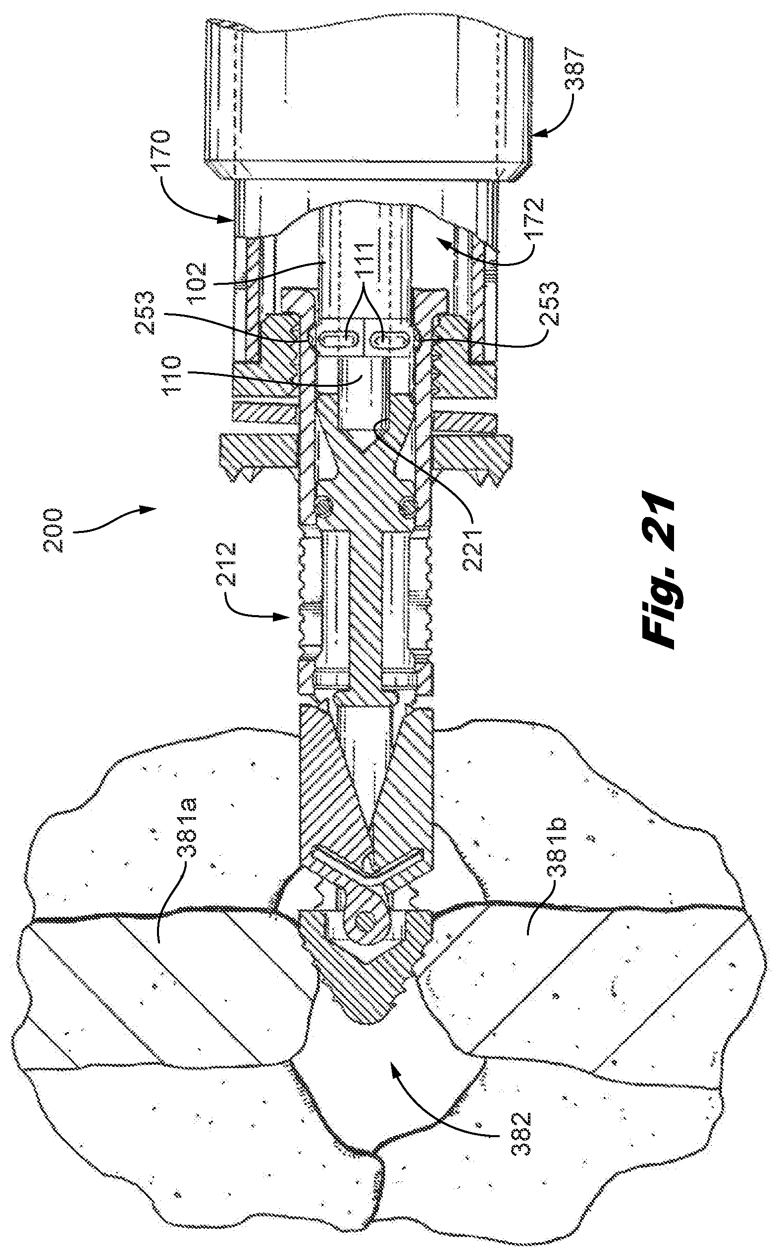 Patent US12588935 Figure 12 – Interspinous implant insertion instrument with staggered path implant deployment mechanism