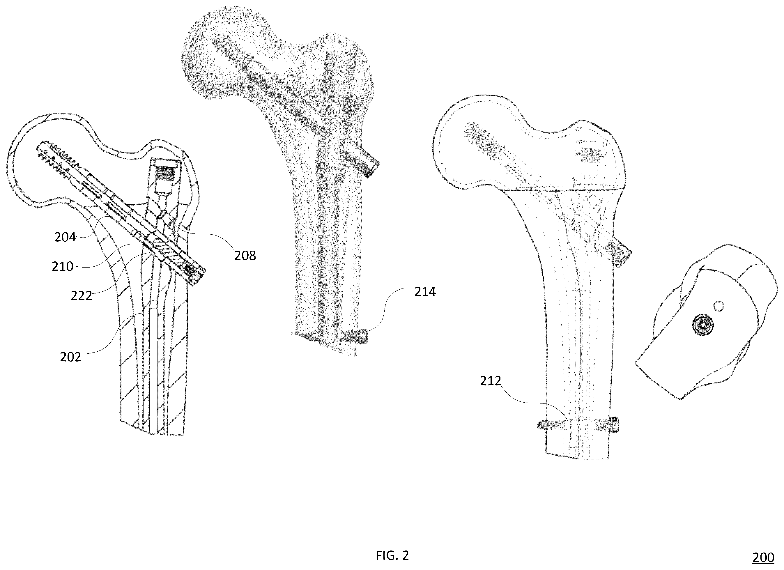 Patent US12588936 Figure 2 – Lag screw systems and nail systems and methods incorporating the same