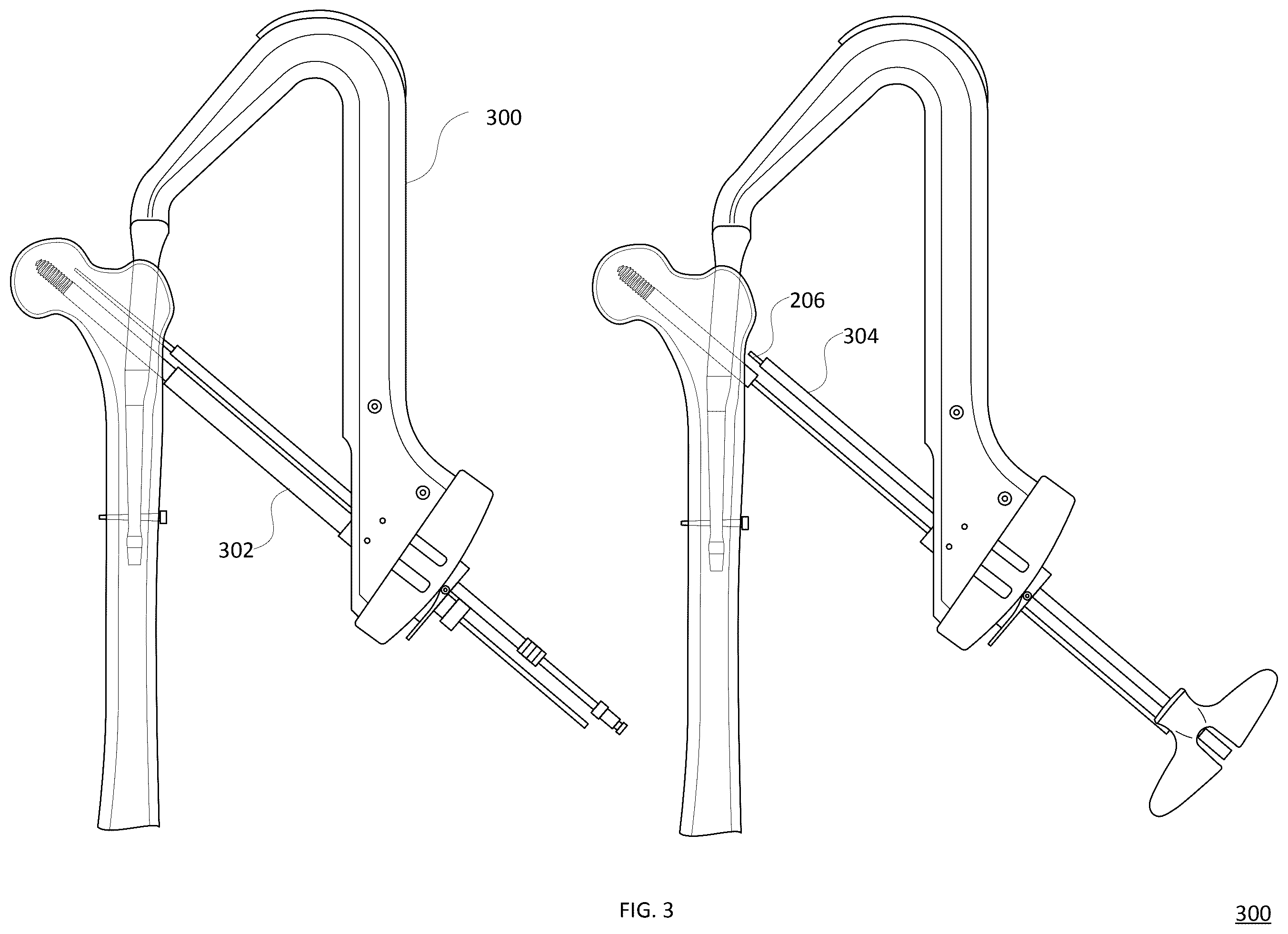 Patent US12588936 Figure 3 – Lag screw systems and nail systems and methods incorporating the same