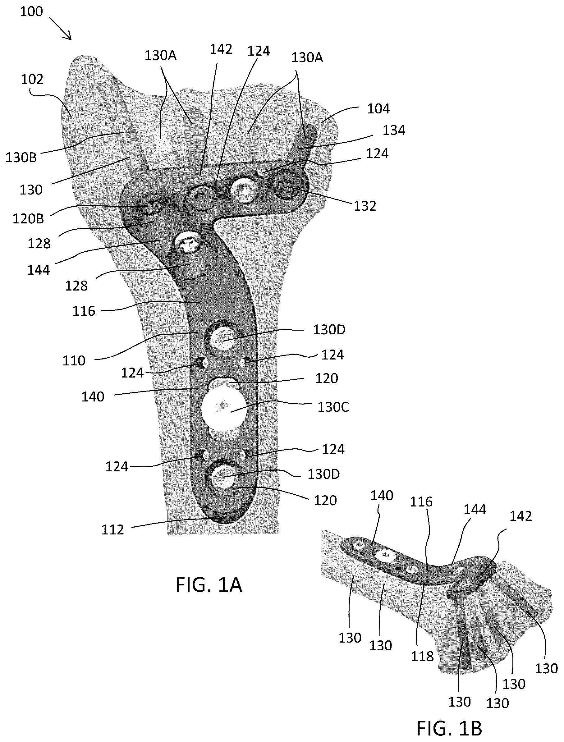 Patent US12588937 Figure 1 – Volar distal radius stabilization system