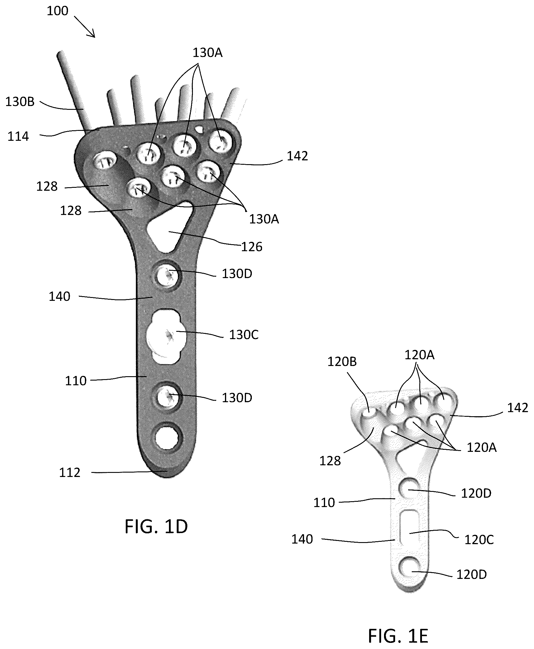 Patent US12588937 Figure 3 – Volar distal radius stabilization system