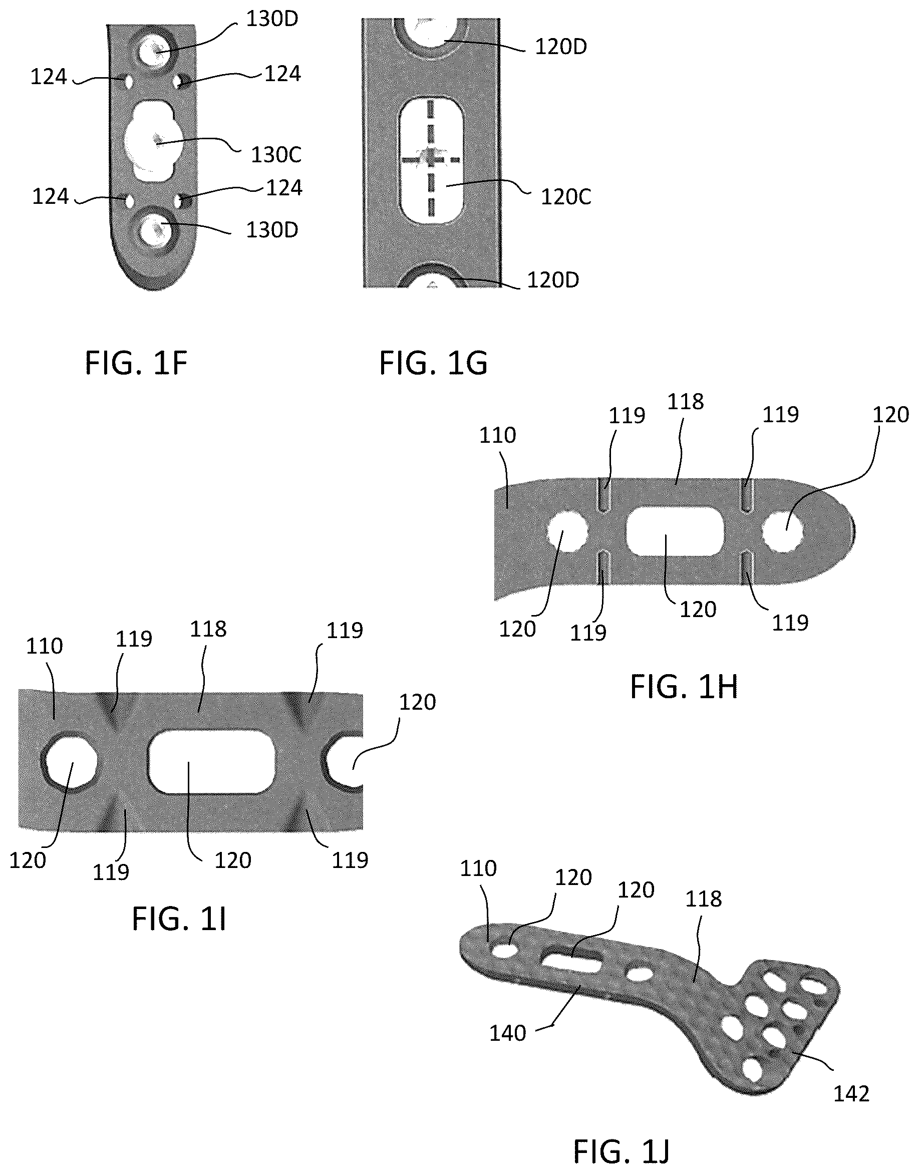Patent US12588937 Figure 4 – Volar distal radius stabilization system