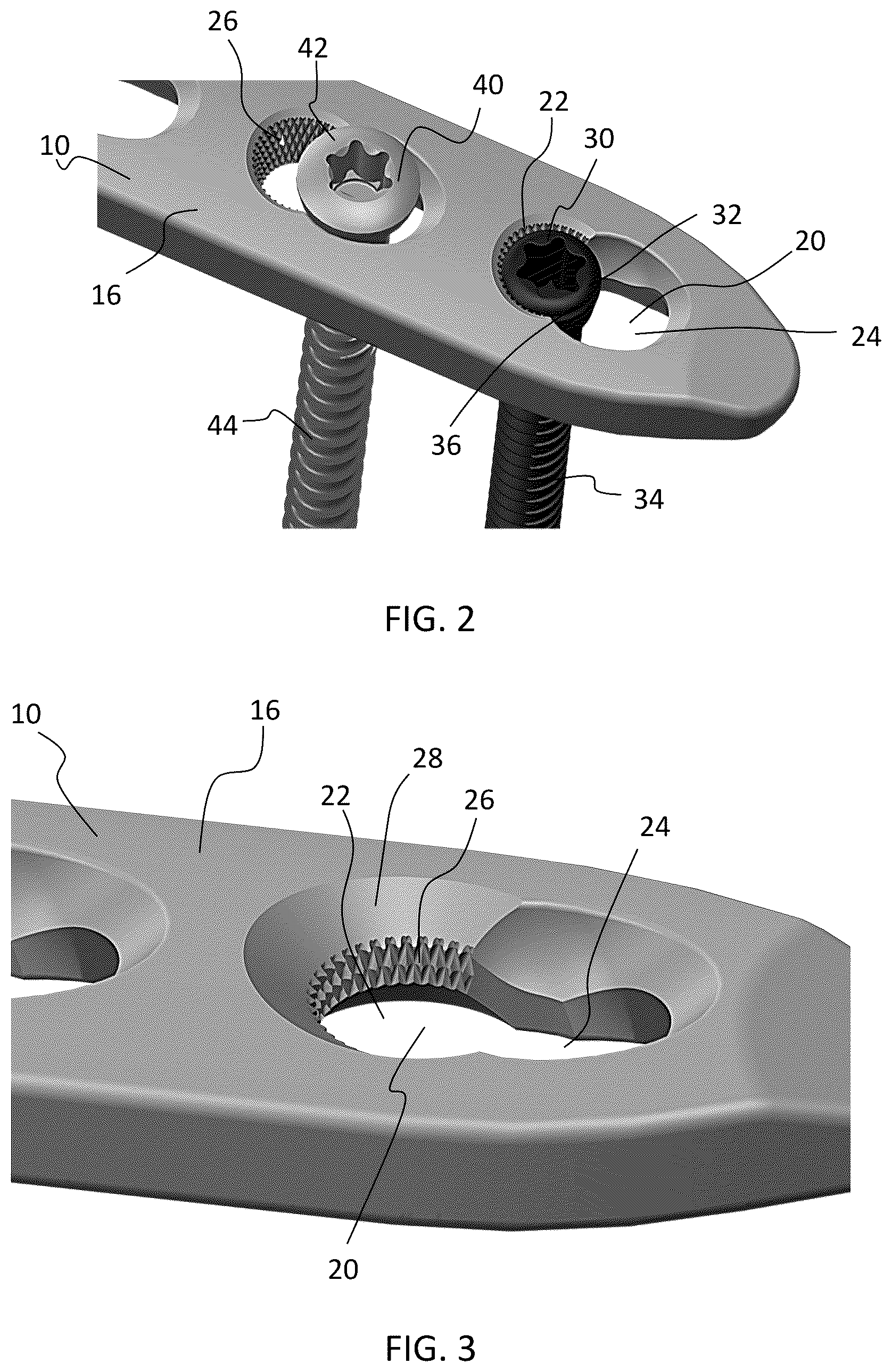 Patent US12588937 Figure 5 – Volar distal radius stabilization system