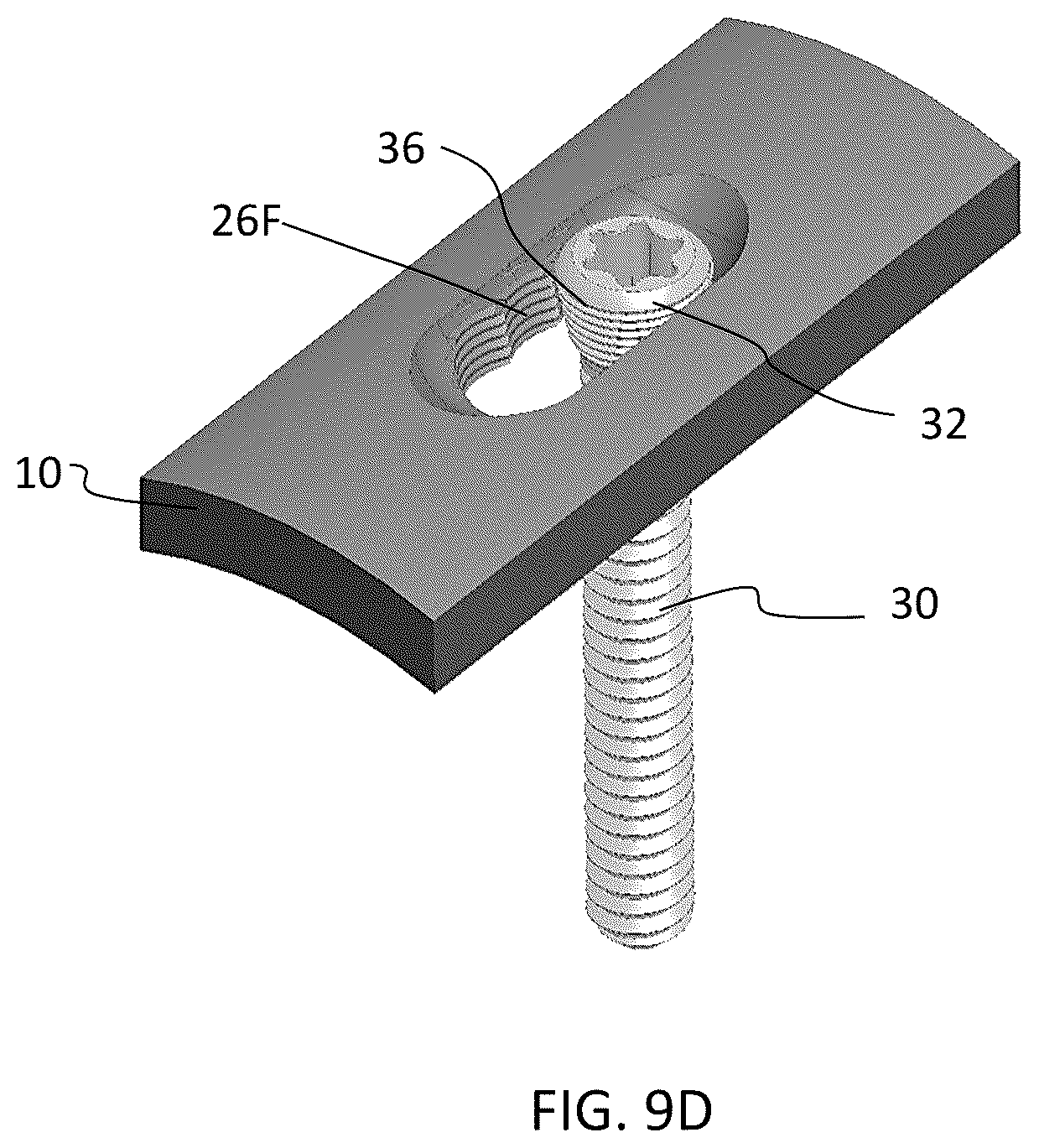 Patent US12588937 Figure 12 – Volar distal radius stabilization system