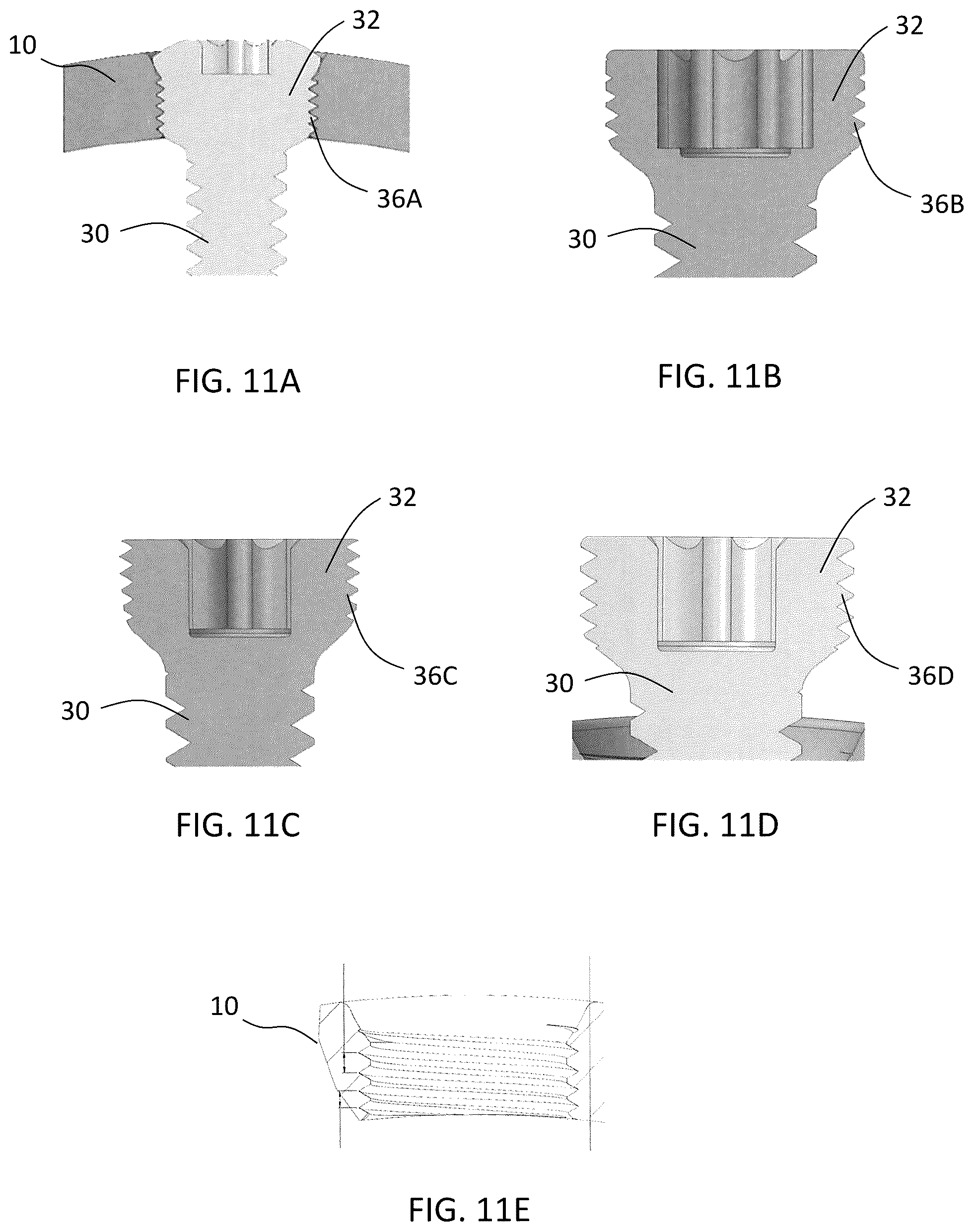 Patent US12588937 Figure 14 – Volar distal radius stabilization system