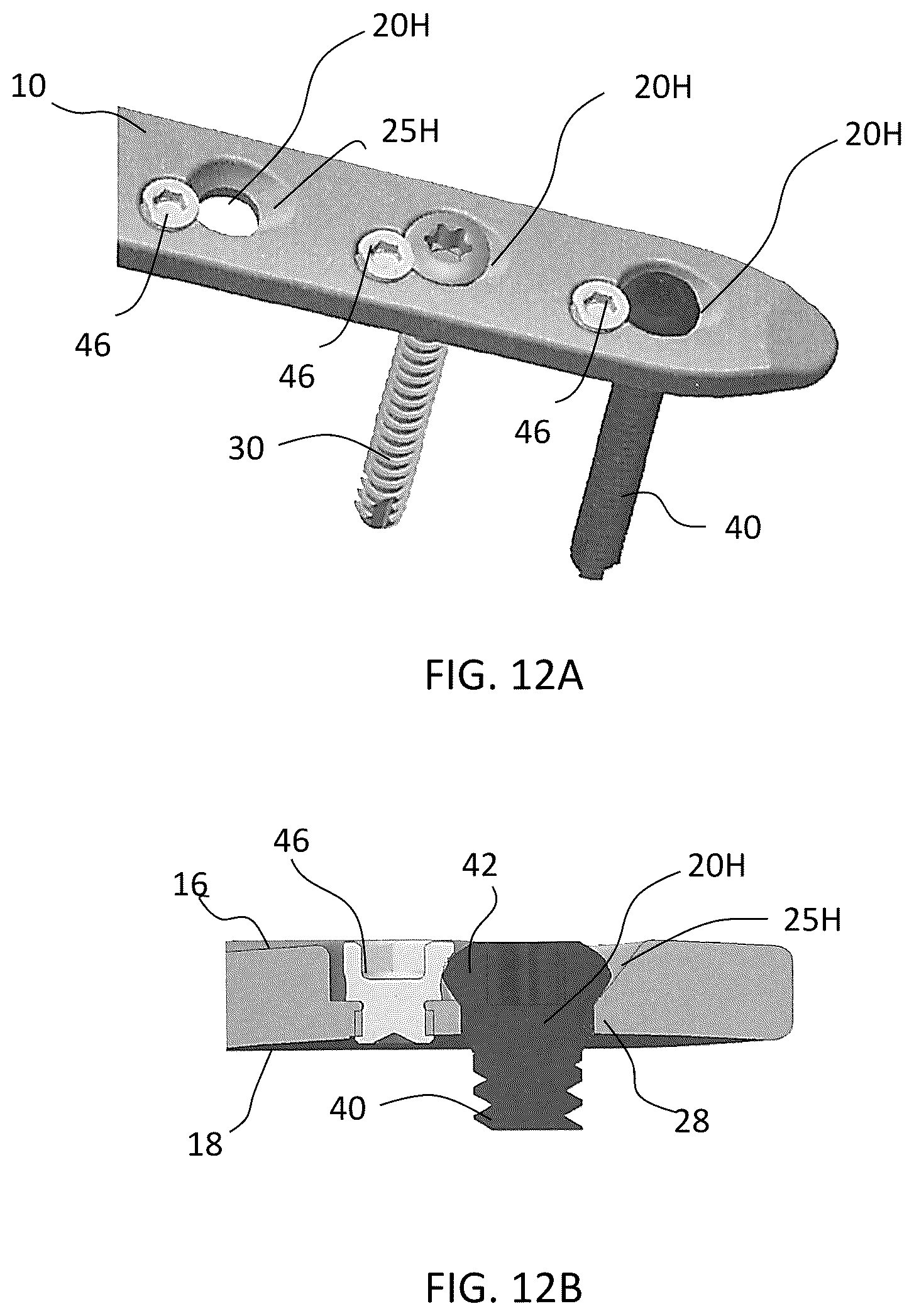 Patent US12588937 Figure 15 – Volar distal radius stabilization system
