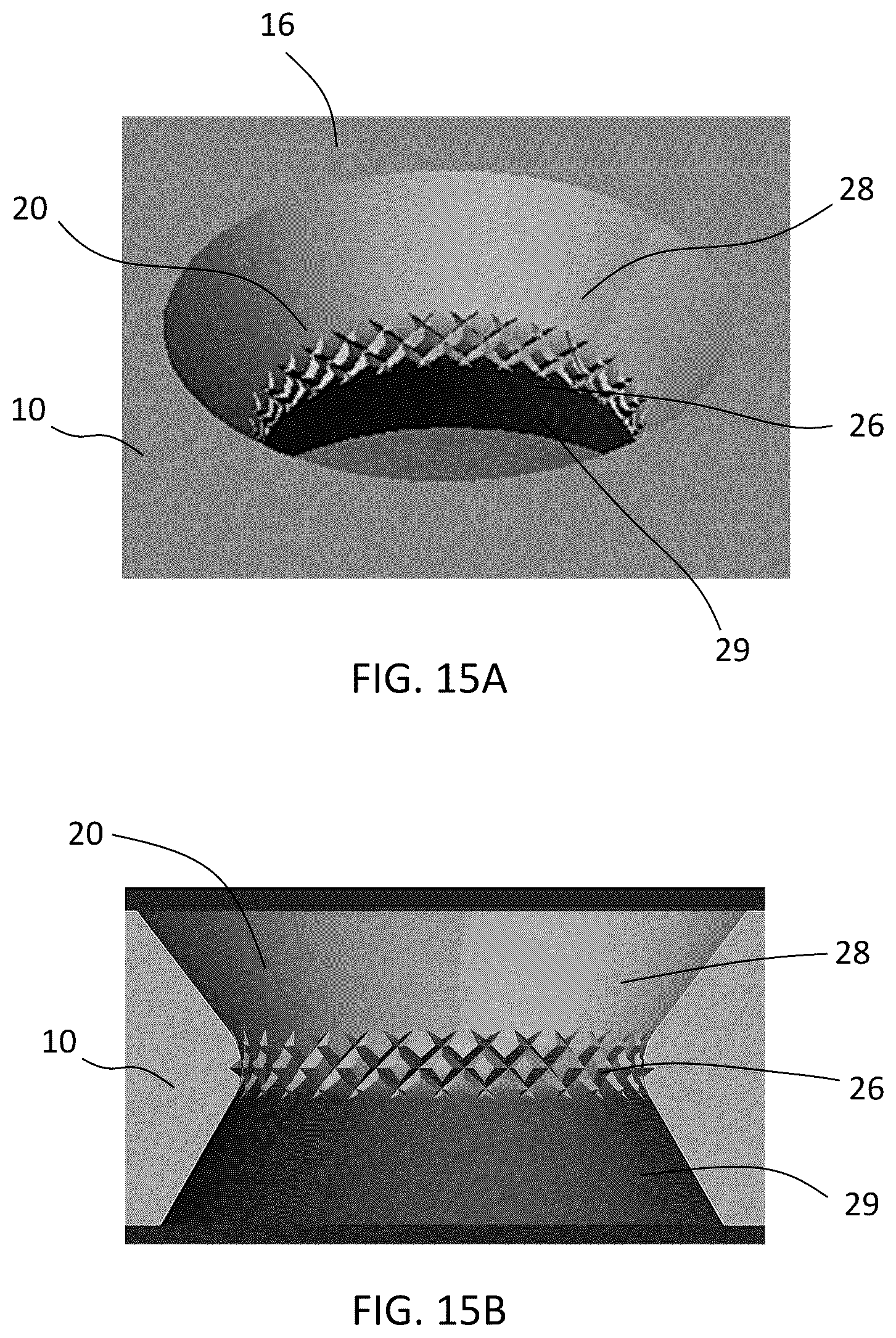 Patent US12588937 Figure 18 – Volar distal radius stabilization system