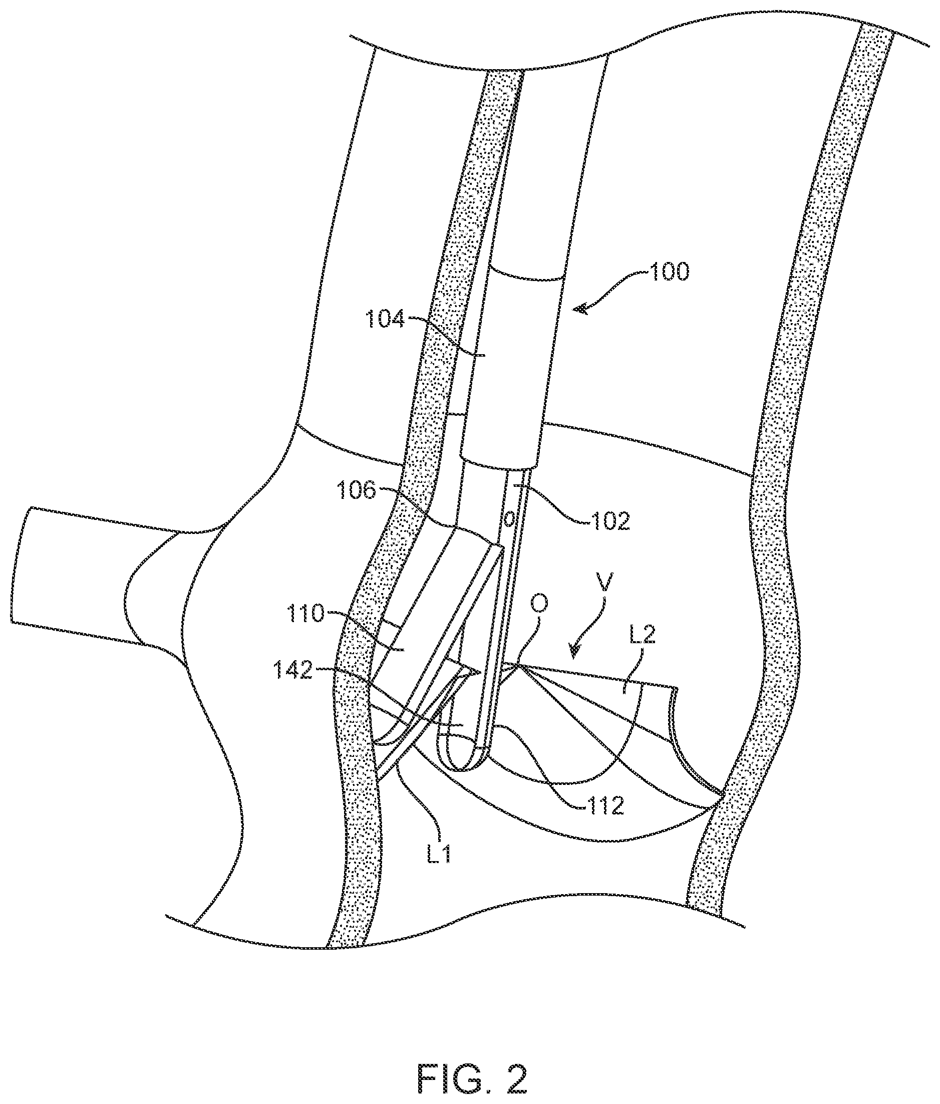 Patent US12588945 Figure 4 – Devices and methods for preparing a valve for a transcatheter valve replacement procedure