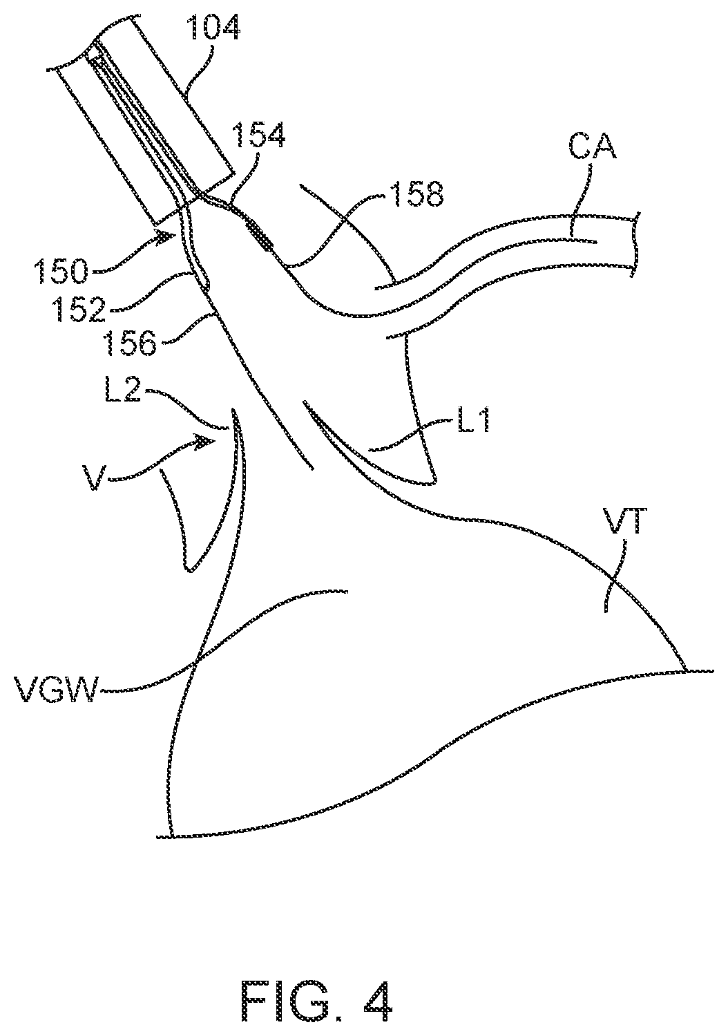 Patent US12588945 Figure 6 – Devices and methods for preparing a valve for a transcatheter valve replacement procedure