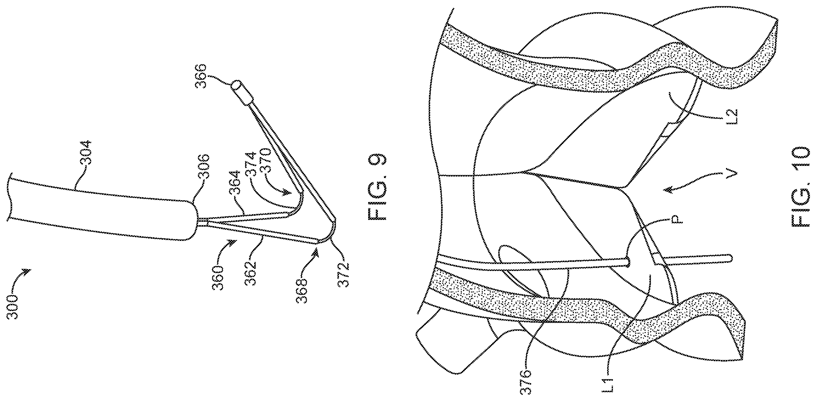 Patent US12588945 Figure 9 – Devices and methods for preparing a valve for a transcatheter valve replacement procedure