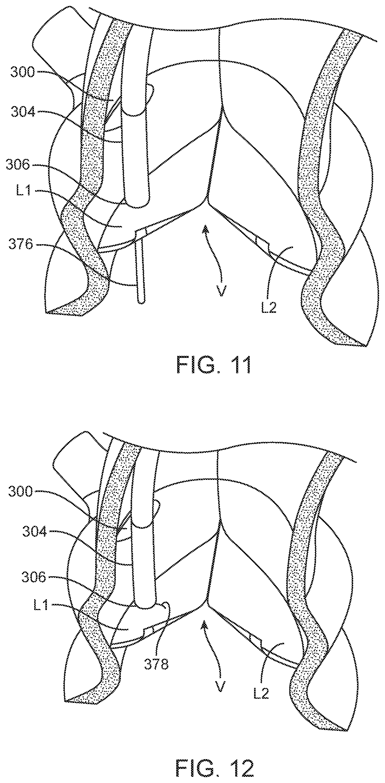 Patent US12588945 Figure 10 – Devices and methods for preparing a valve for a transcatheter valve replacement procedure