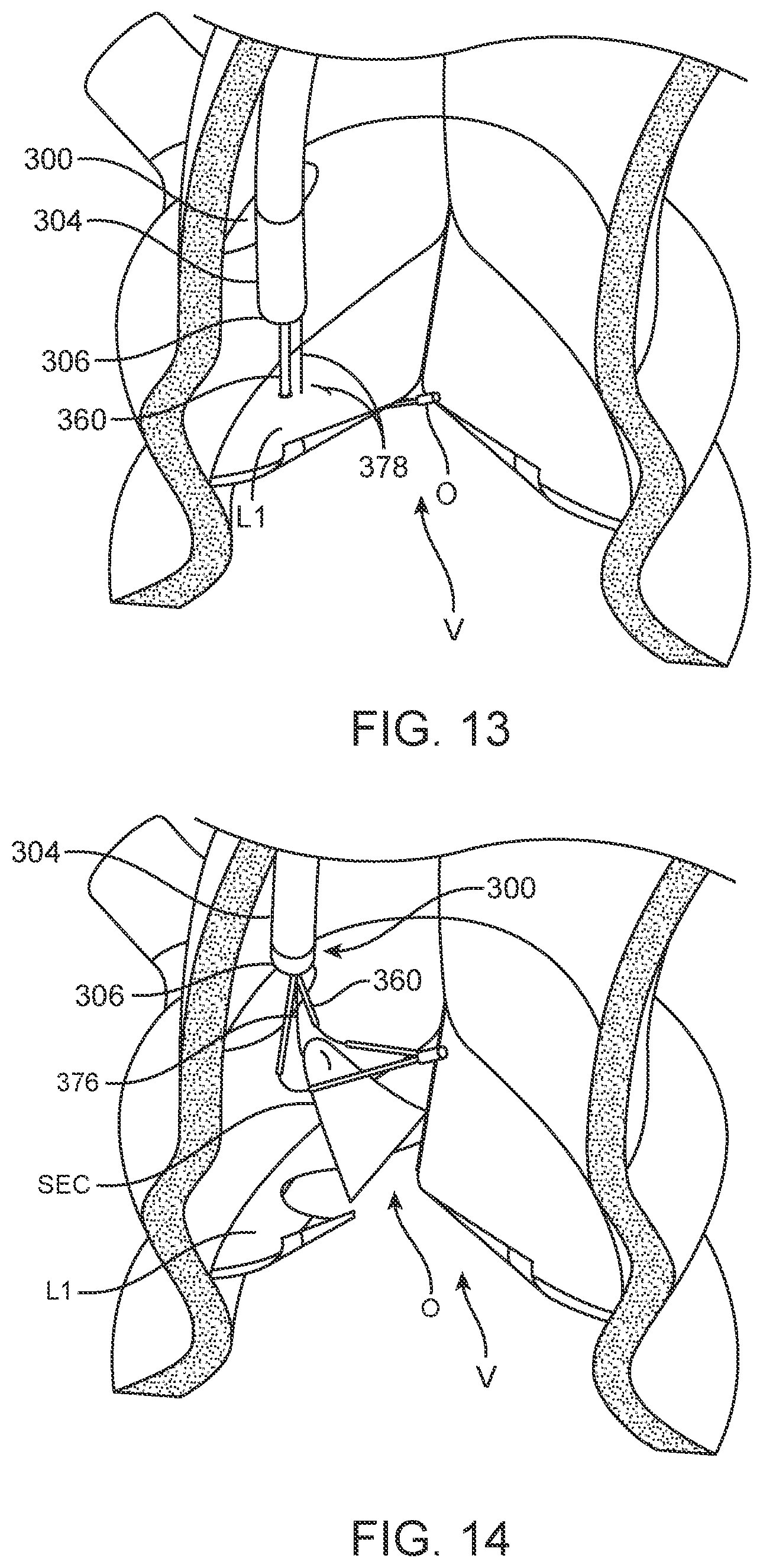 Patent US12588945 Figure 11 – Devices and methods for preparing a valve for a transcatheter valve replacement procedure