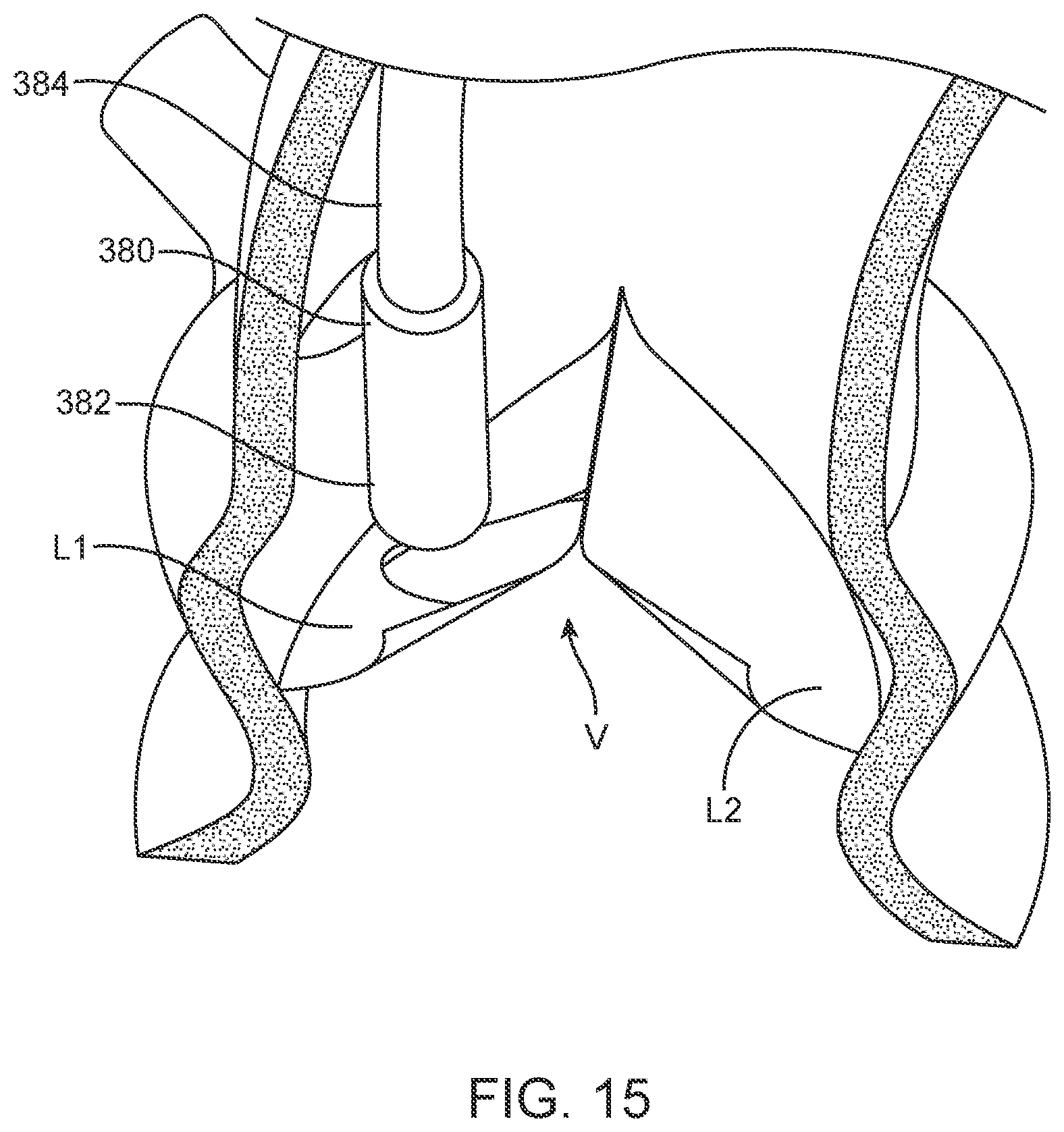 Patent US12588945 Figure 12 – Devices and methods for preparing a valve for a transcatheter valve replacement procedure