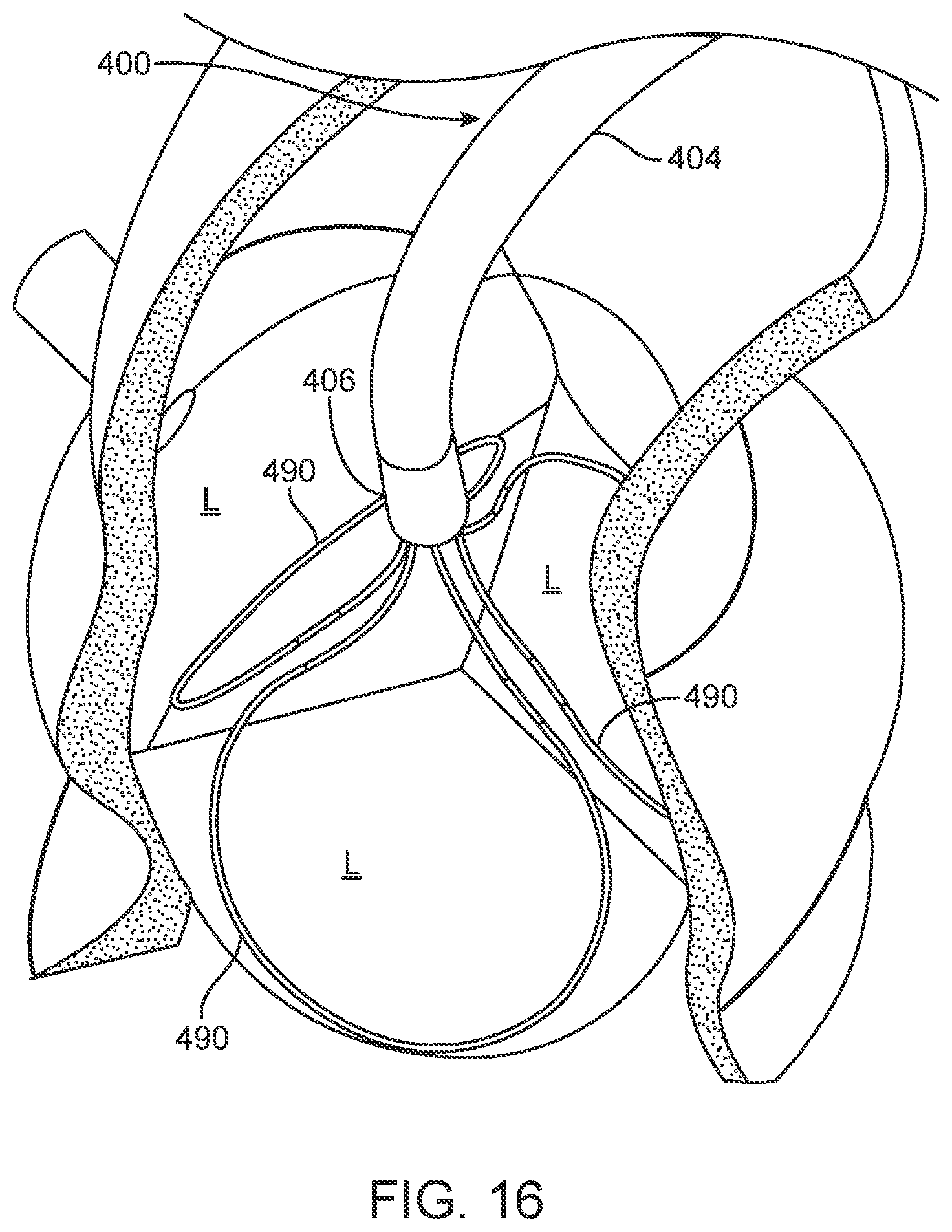 Patent US12588945 Figure 13 – Devices and methods for preparing a valve for a transcatheter valve replacement procedure