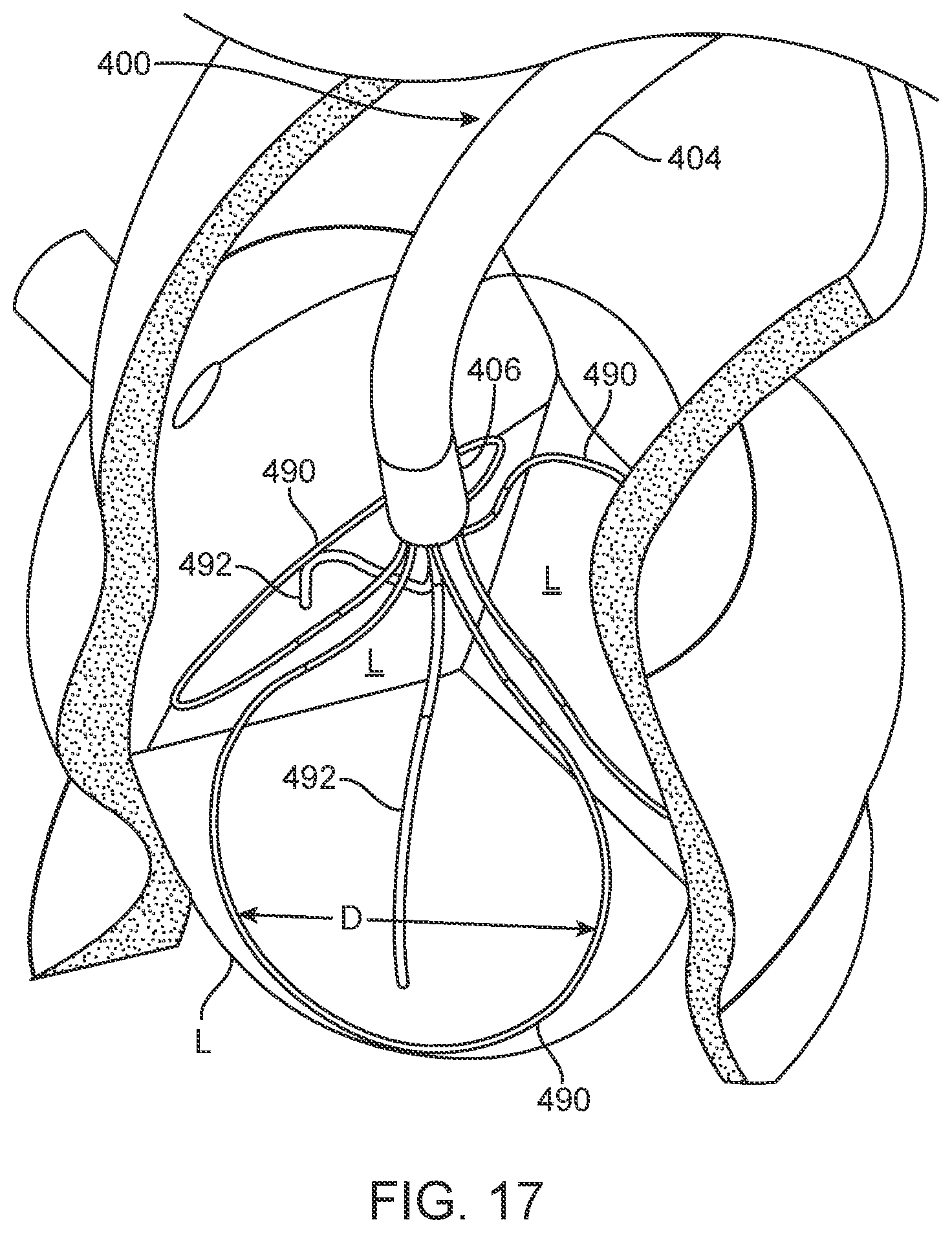 Patent US12588945 Figure 14 – Devices and methods for preparing a valve for a transcatheter valve replacement procedure