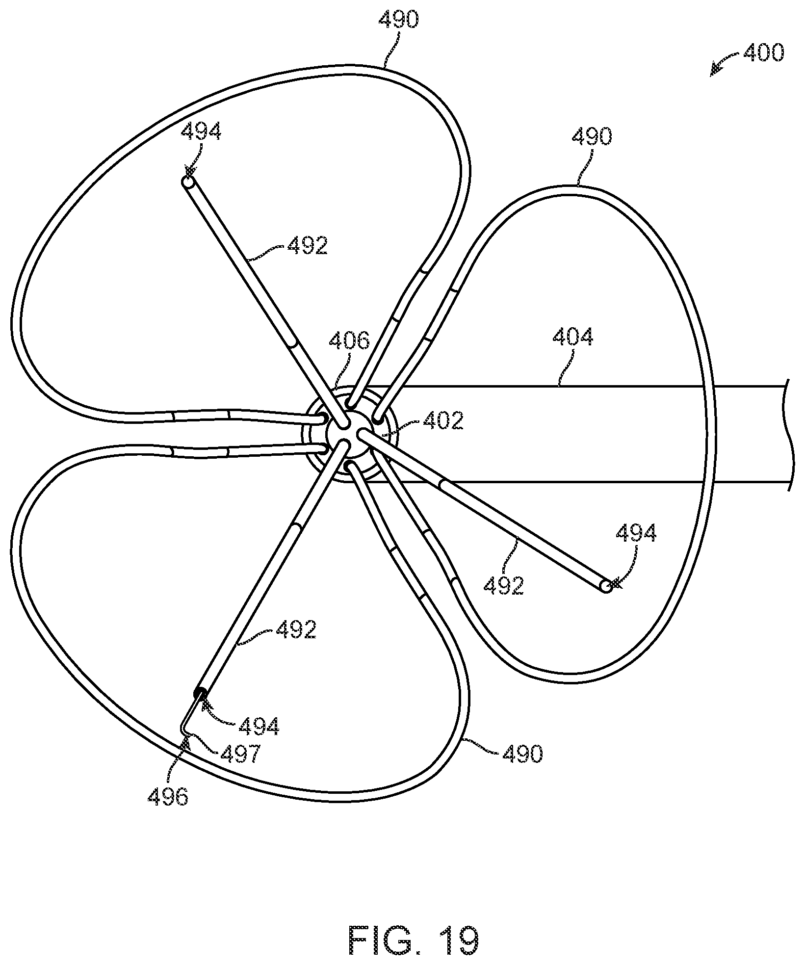 Patent US12588945 Figure 16 – Devices and methods for preparing a valve for a transcatheter valve replacement procedure