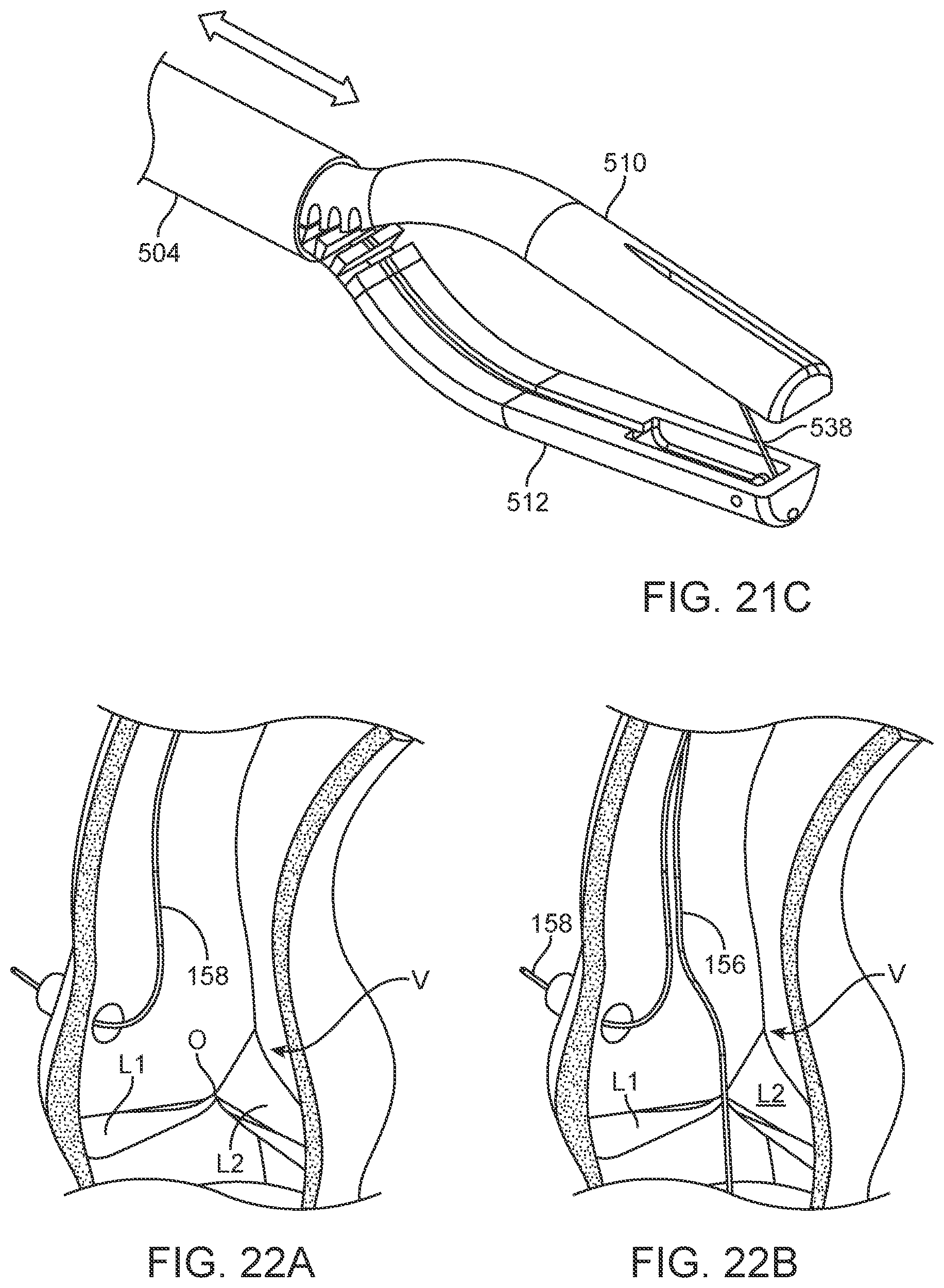 Patent US12588945 Figure 20 – Devices and methods for preparing a valve for a transcatheter valve replacement procedure