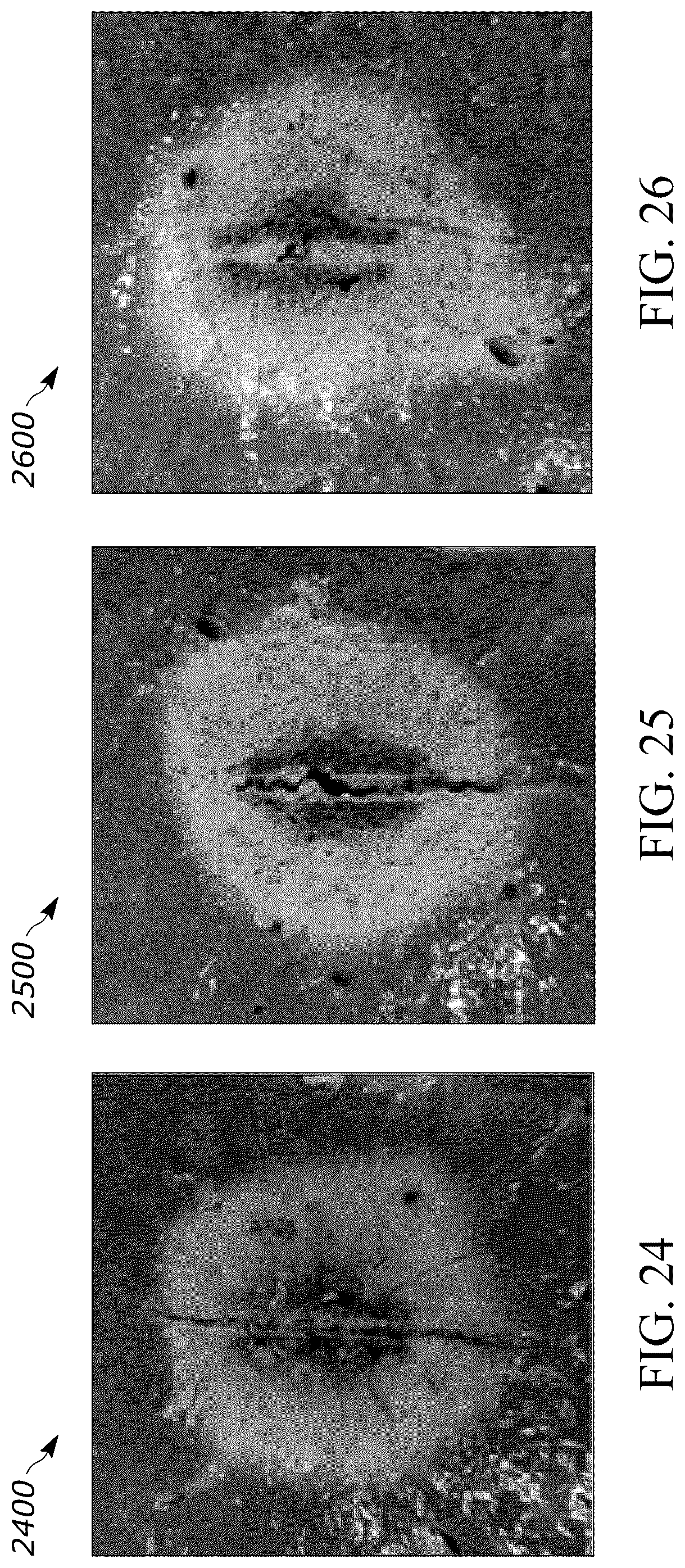 Patent US12588948 Figure 11 – Fluid-cooled low-profile microwave ablation probe with spherical ablation zone