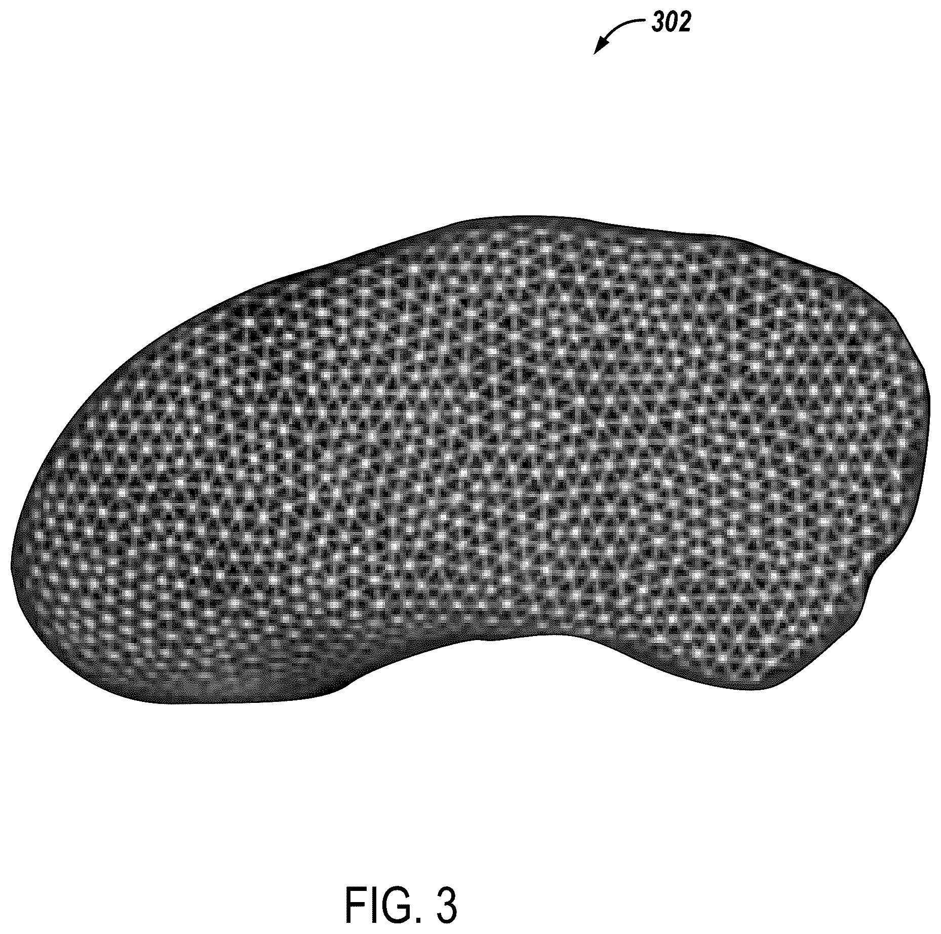Patent US12588950 Figure 3 – Trajectory planning for minimally invasive therapy delivery using local mesh geometry