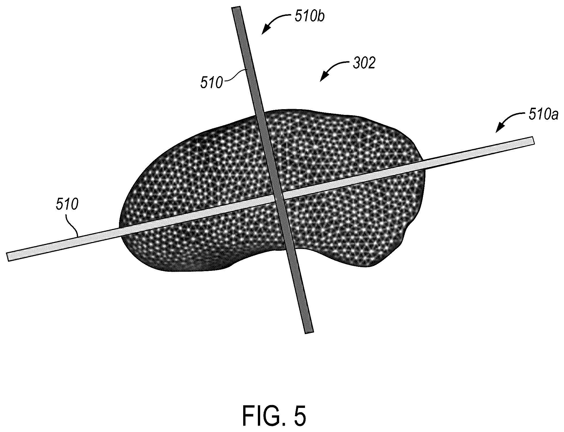 Patent US12588950 Figure 5 – Trajectory planning for minimally invasive therapy delivery using local mesh geometry