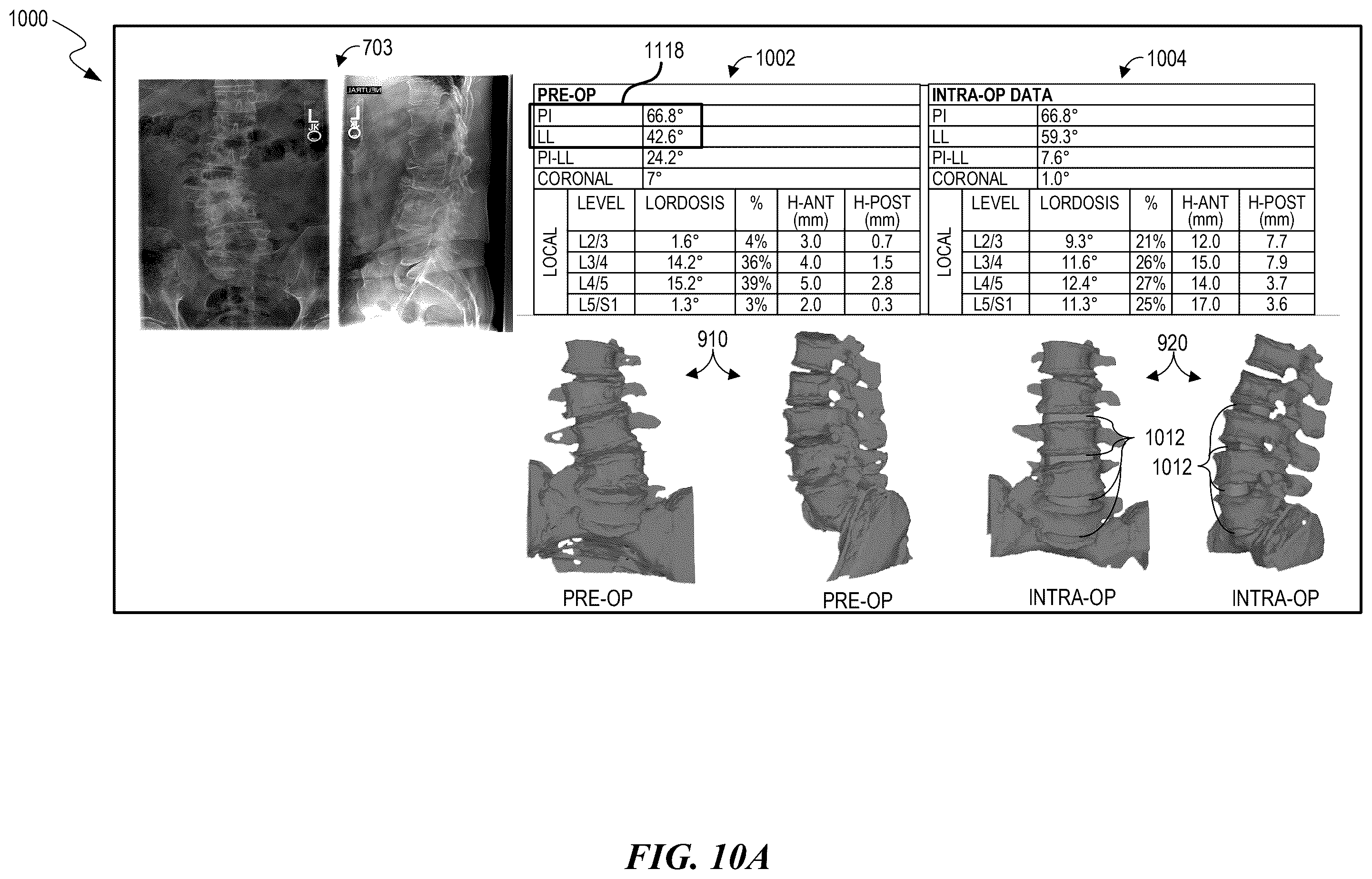 Patent US12588951 Figure 16 – Patient-specific implant design and manufacturing system with a surgical implant positioning manager