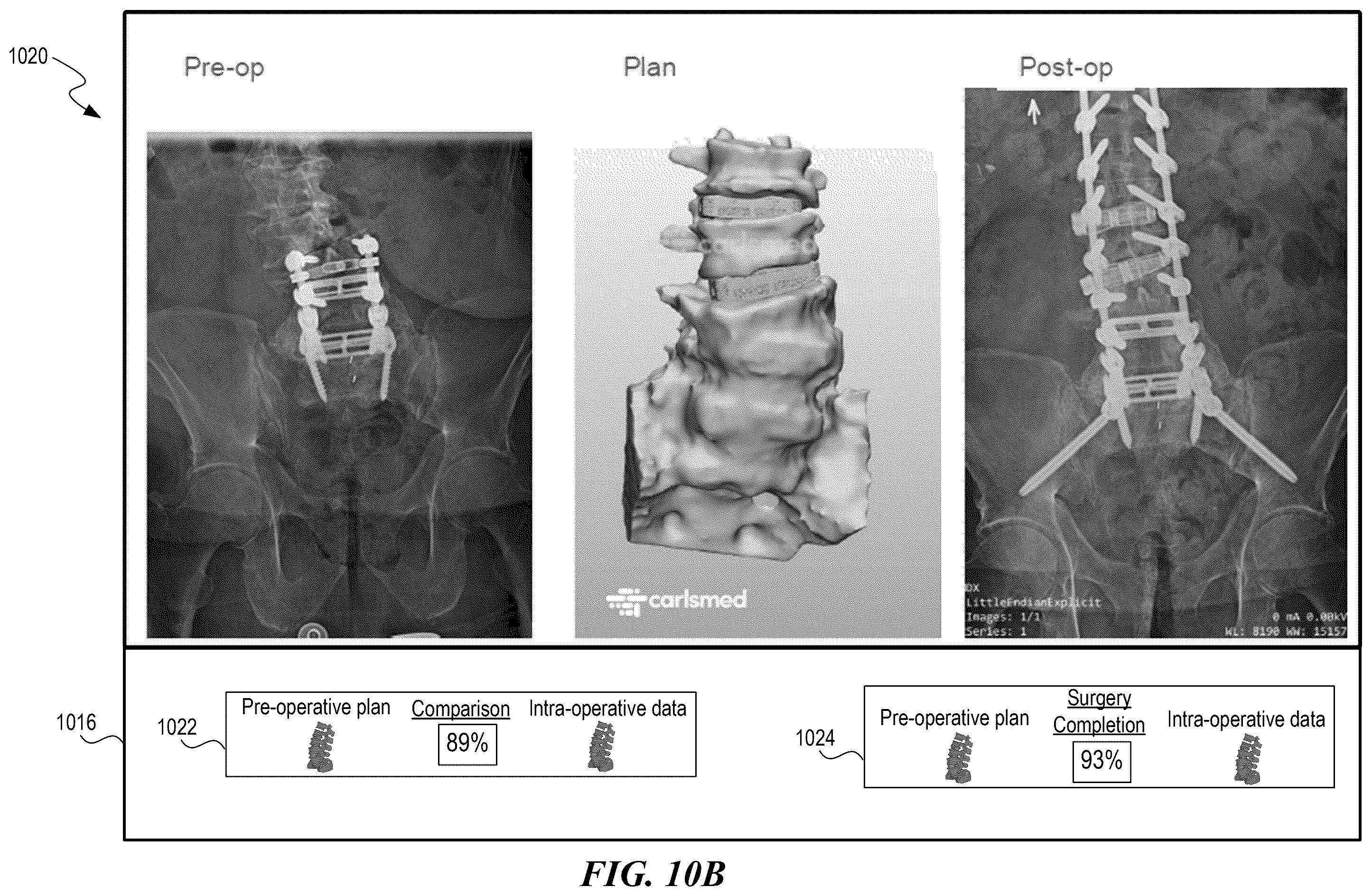 Patent US12588951 Figure 17 – Patient-specific implant design and manufacturing system with a surgical implant positioning manager