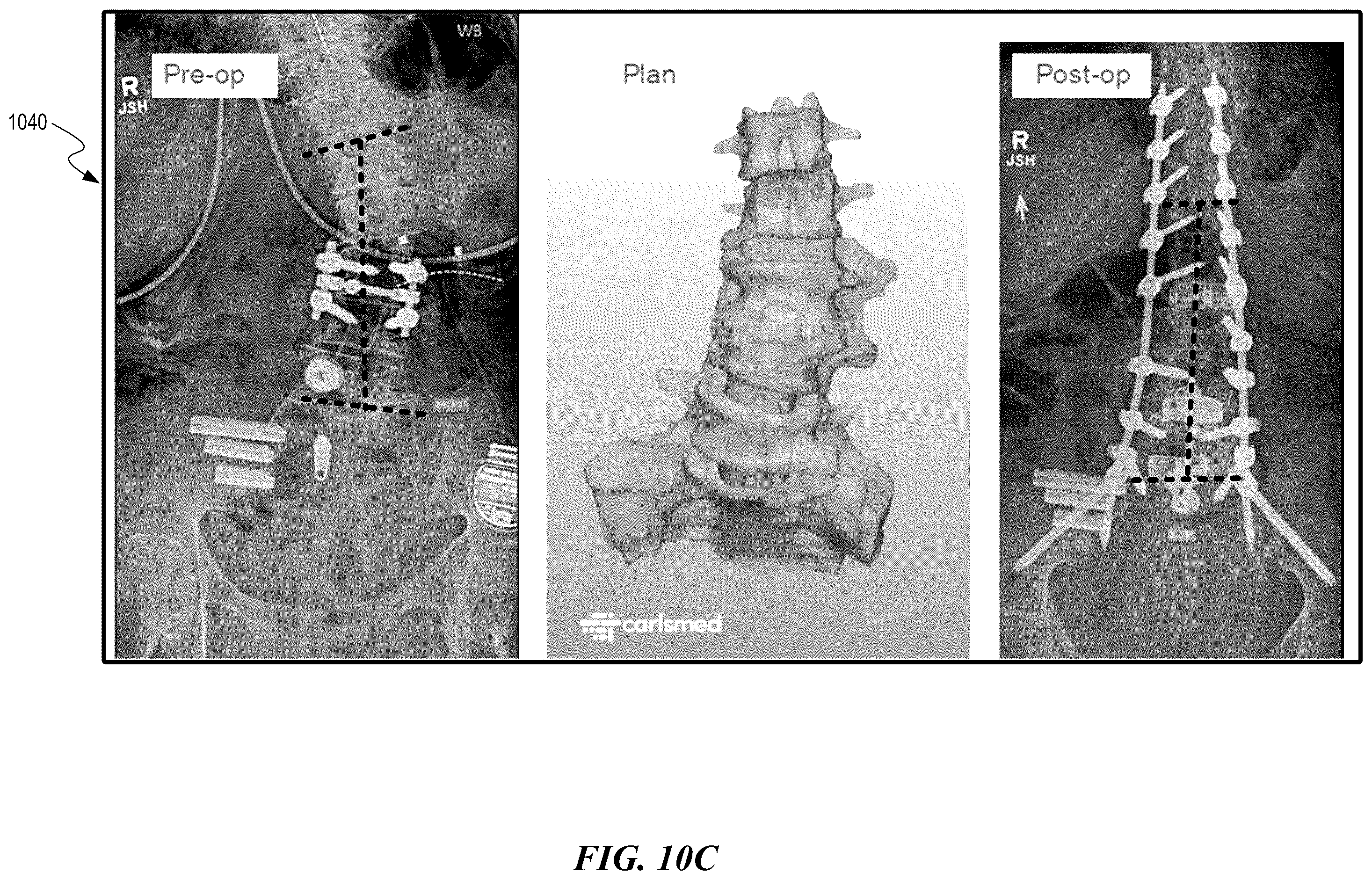Patent US12588951 Figure 18 – Patient-specific implant design and manufacturing system with a surgical implant positioning manager