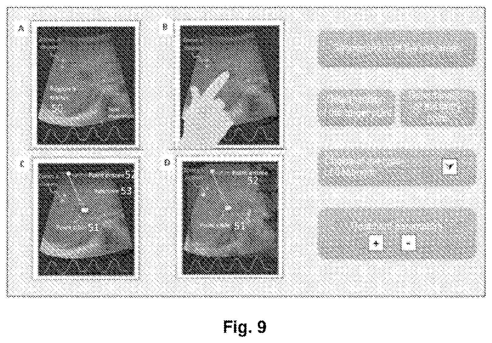 Patent US12588960 Figure 6 – Medical robot for placement of medical instruments under ultrasound guidance