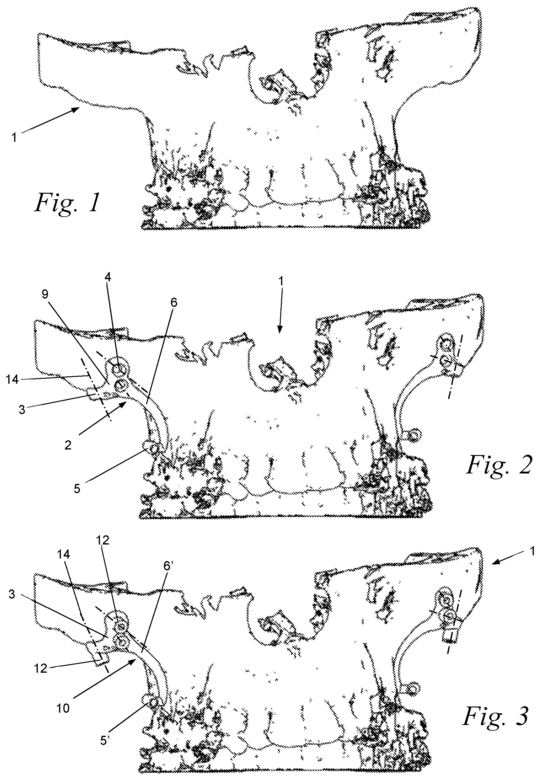 Patent US12588969 Figure 1 – Bone anchor for an upper or lower jaw with a corresponding drilling template