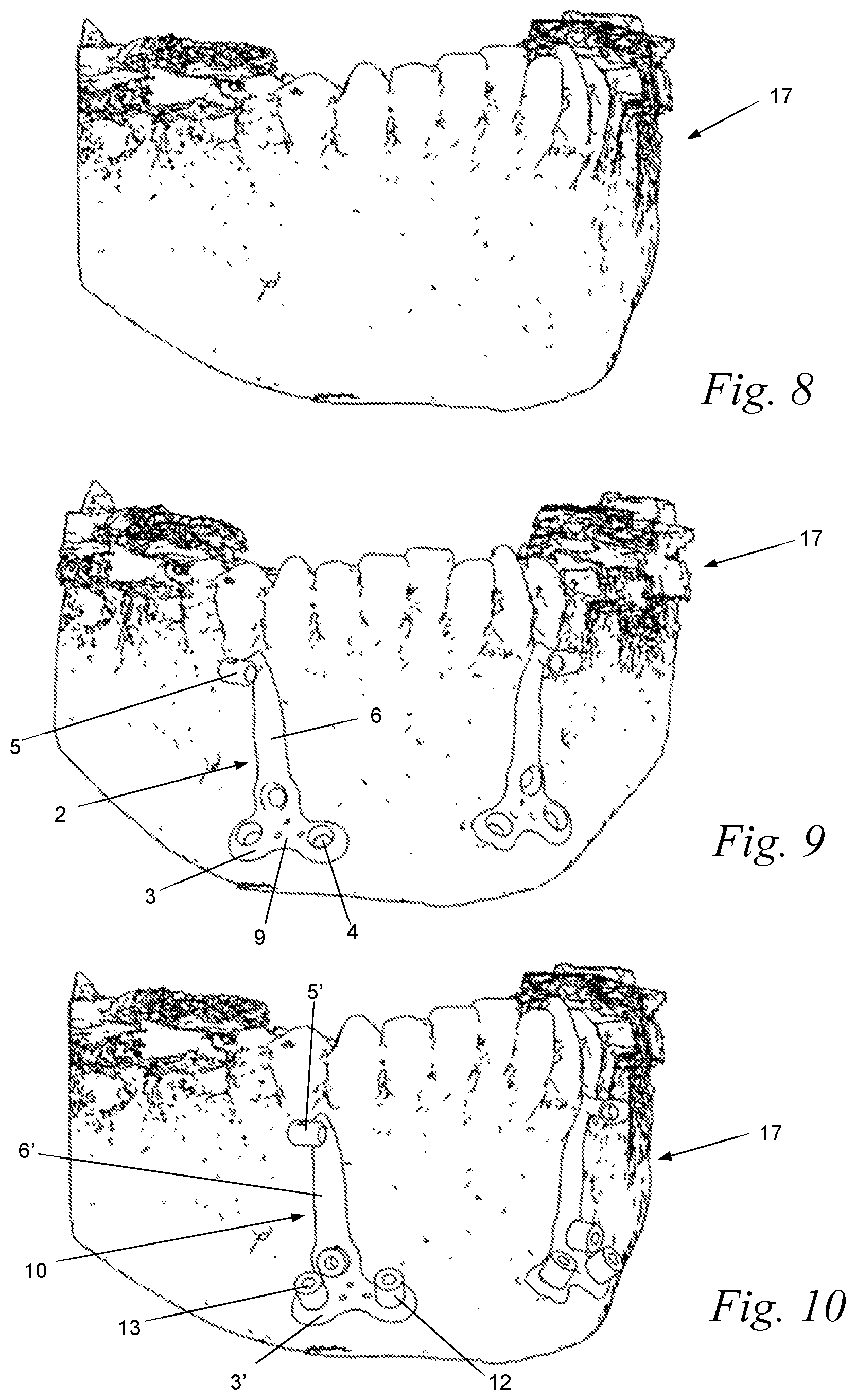 Patent US12588969 Figure 3 – Bone anchor for an upper or lower jaw with a corresponding drilling template