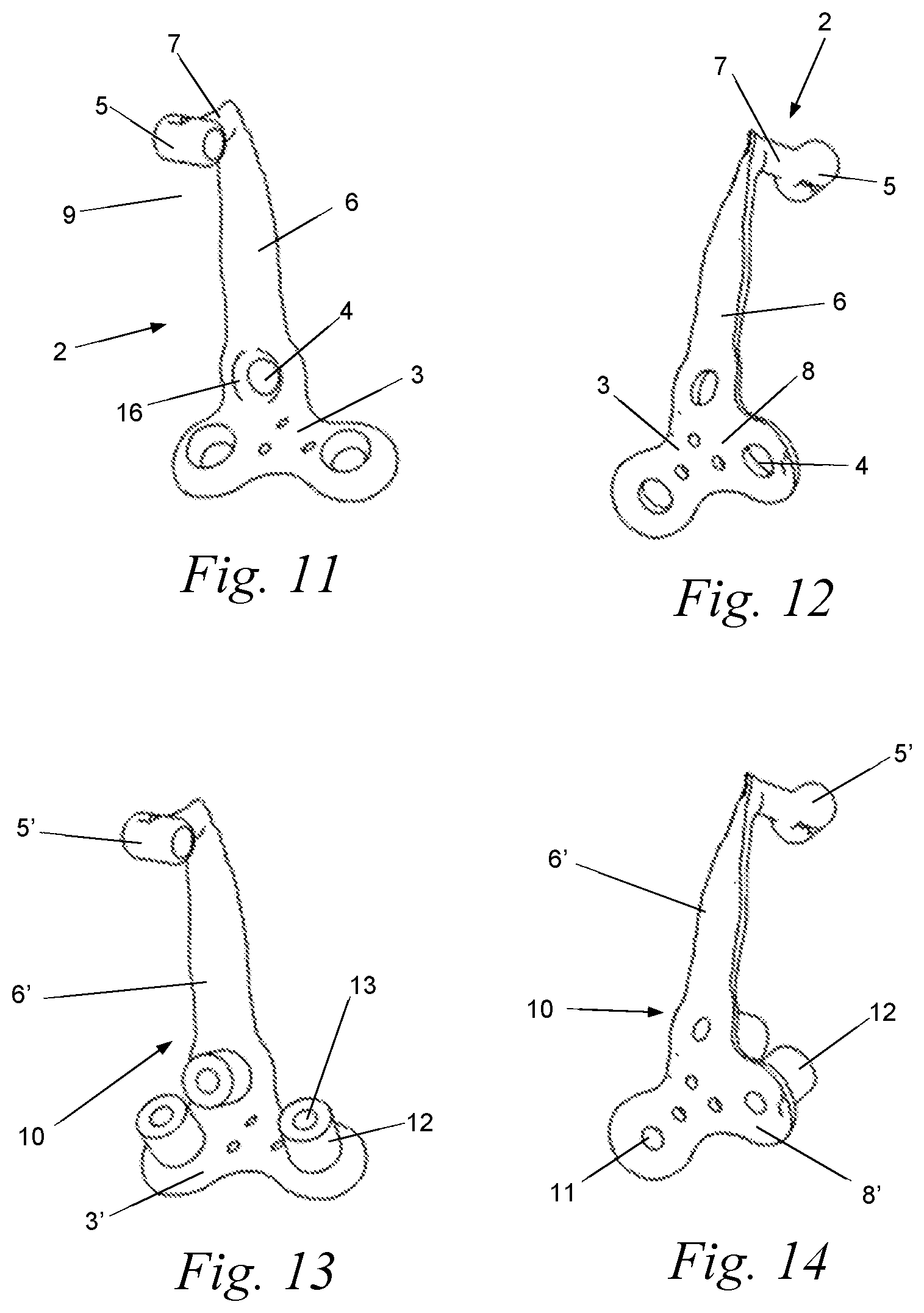 Patent US12588969 Figure 4 – Bone anchor for an upper or lower jaw with a corresponding drilling template