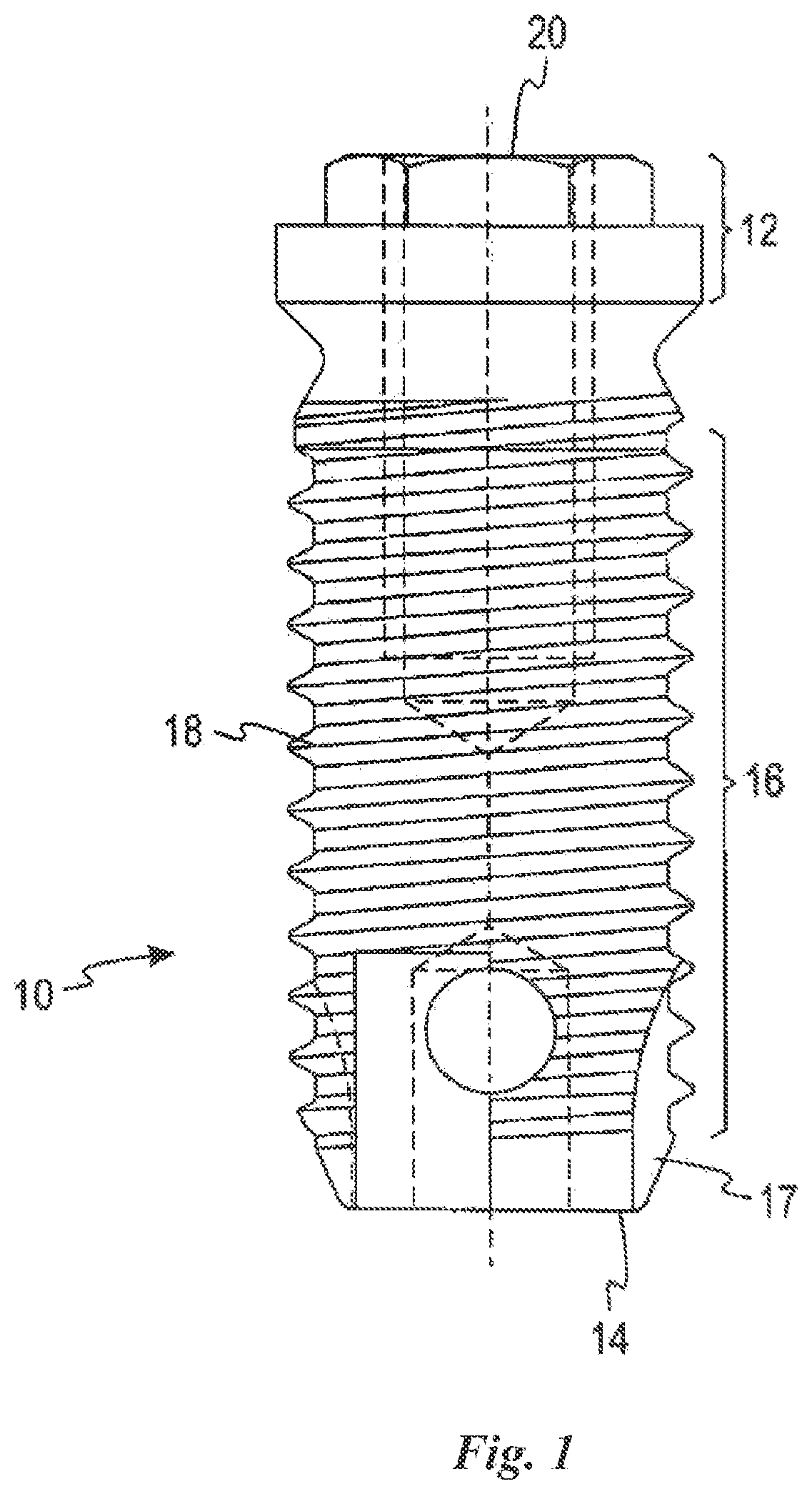 Patent US12588981 Figure 1 – Surface treatment for an implant surface