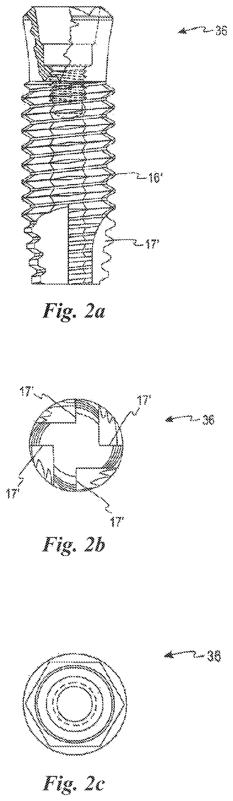 Patent US12588981 Figure 2 – Surface treatment for an implant surface