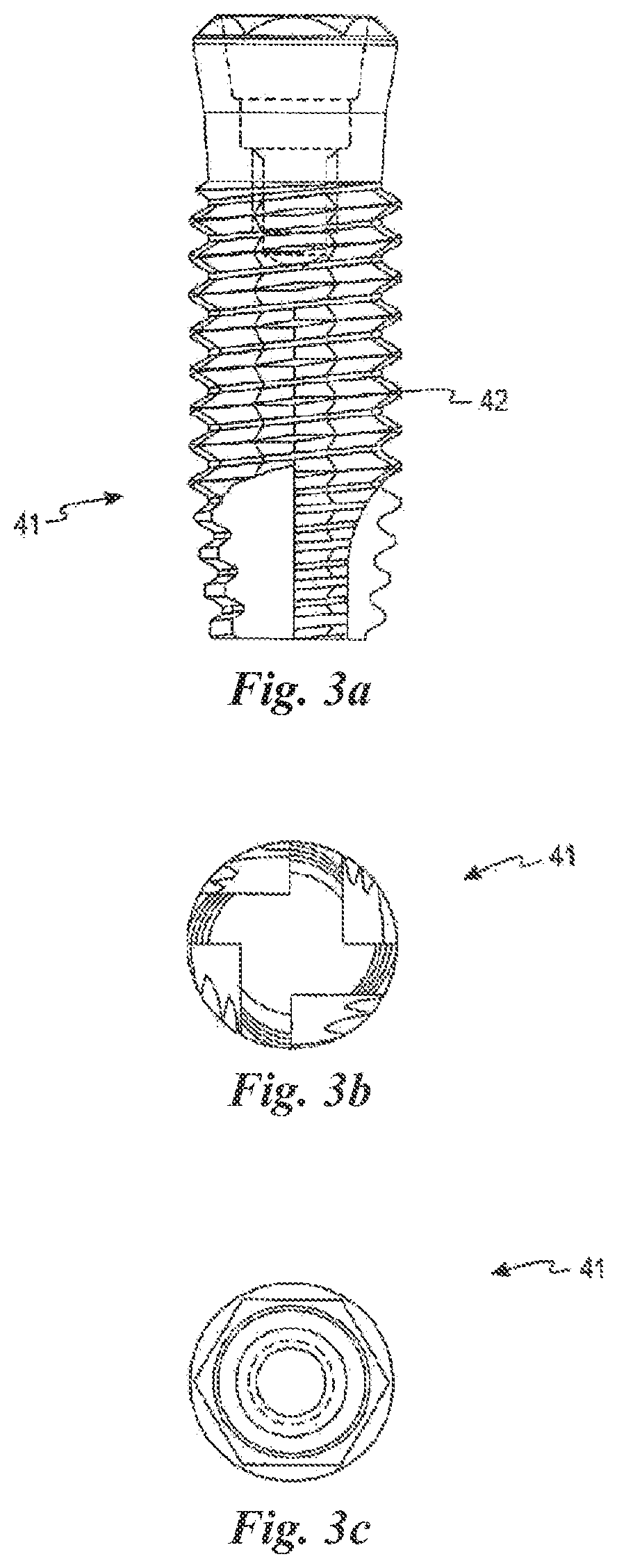 Patent US12588981 Figure 3 – Surface treatment for an implant surface